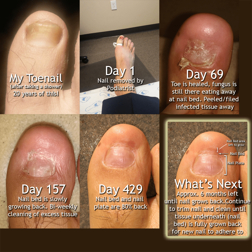 My Nail Progress r/NailFungus