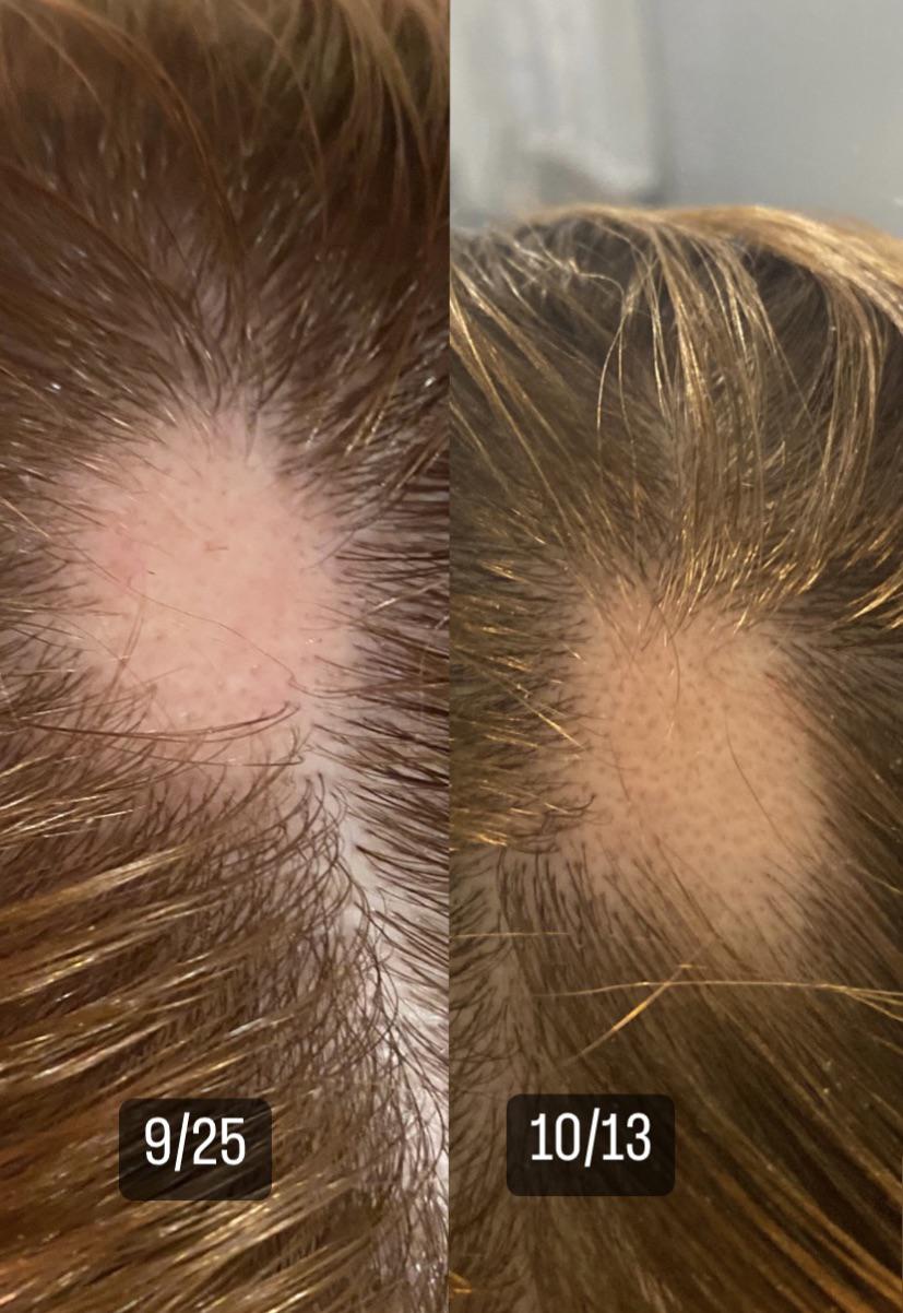 (L) “Exclamation point” hairs vs (R) Regrowth follicles Does this