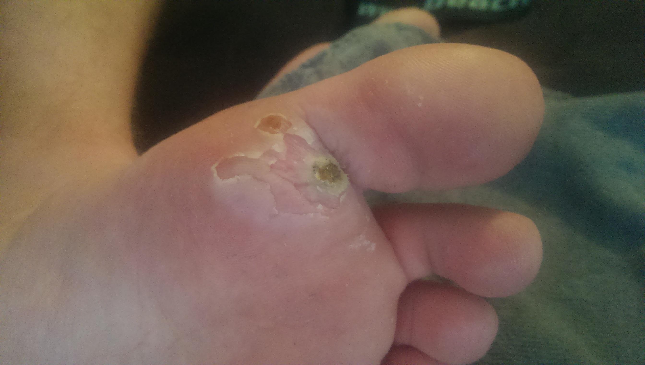 Day 7 of ACV on my wart. Taken right after taking off the