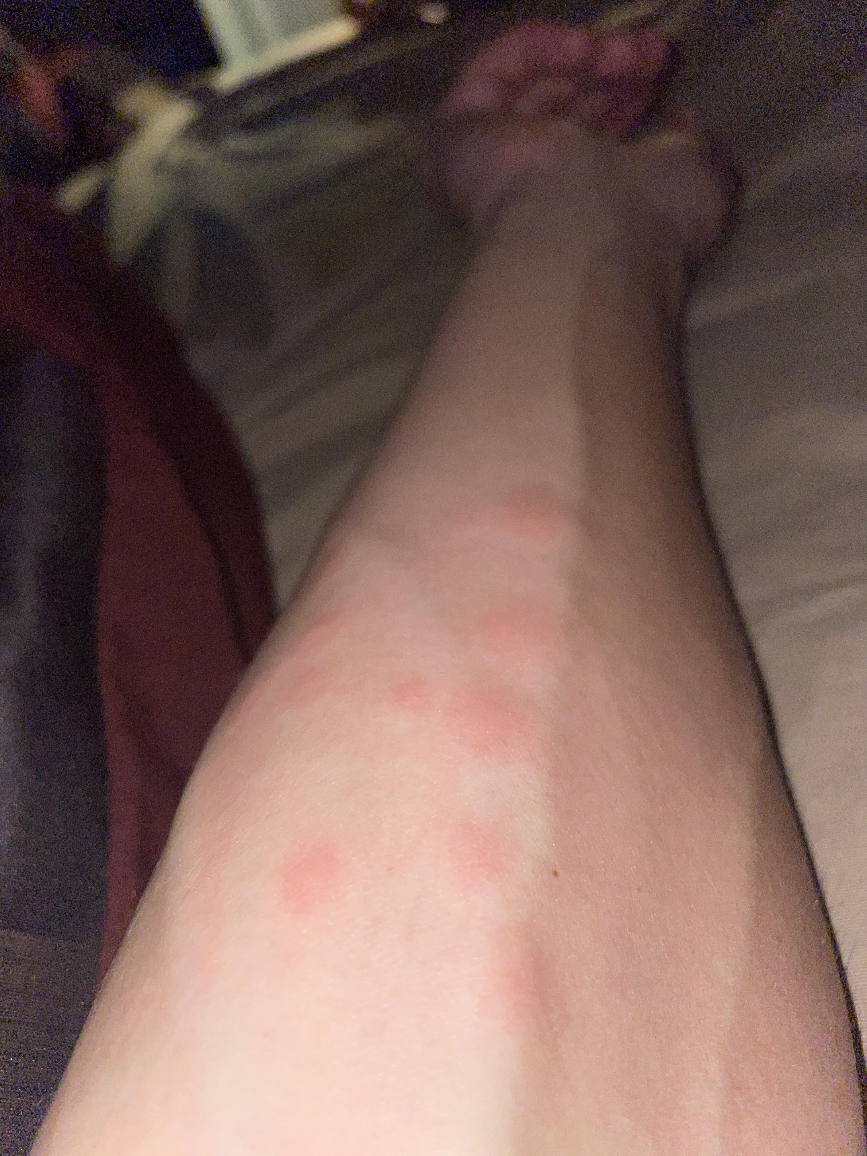 Bed bugs? Mosquito? Itches so bad it hurts. r/bugbites