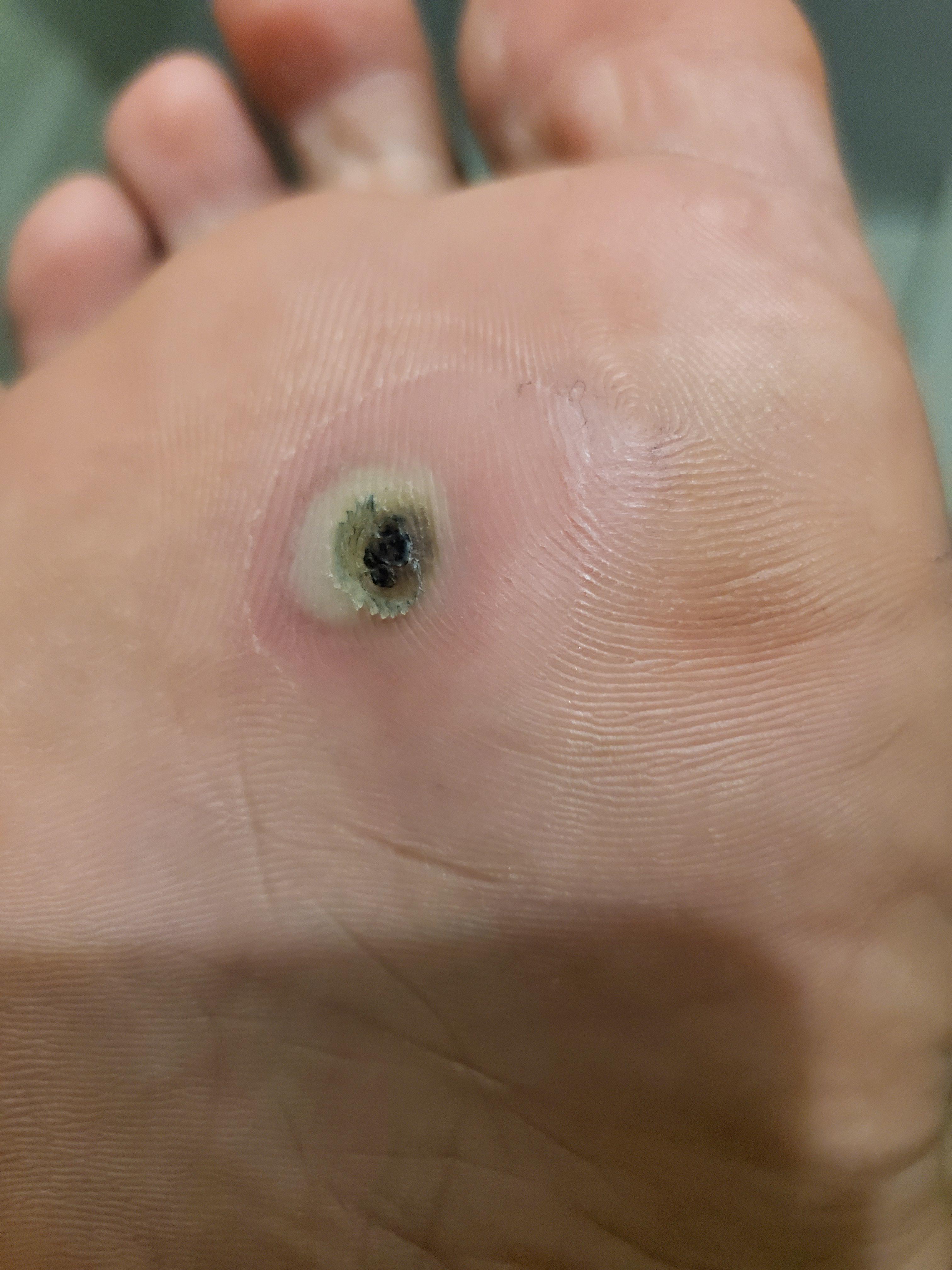 Should I cover my plantar wart (being treated with liquid nitrogen