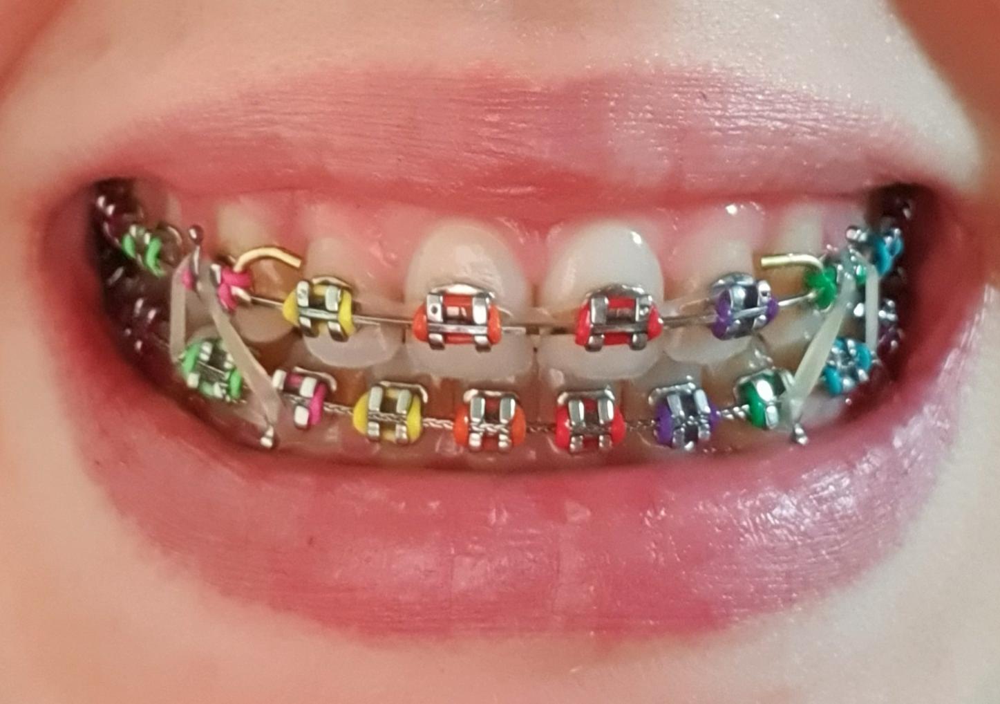 Two more sessions and I will be brace free! Rainbows to celebrate!! r