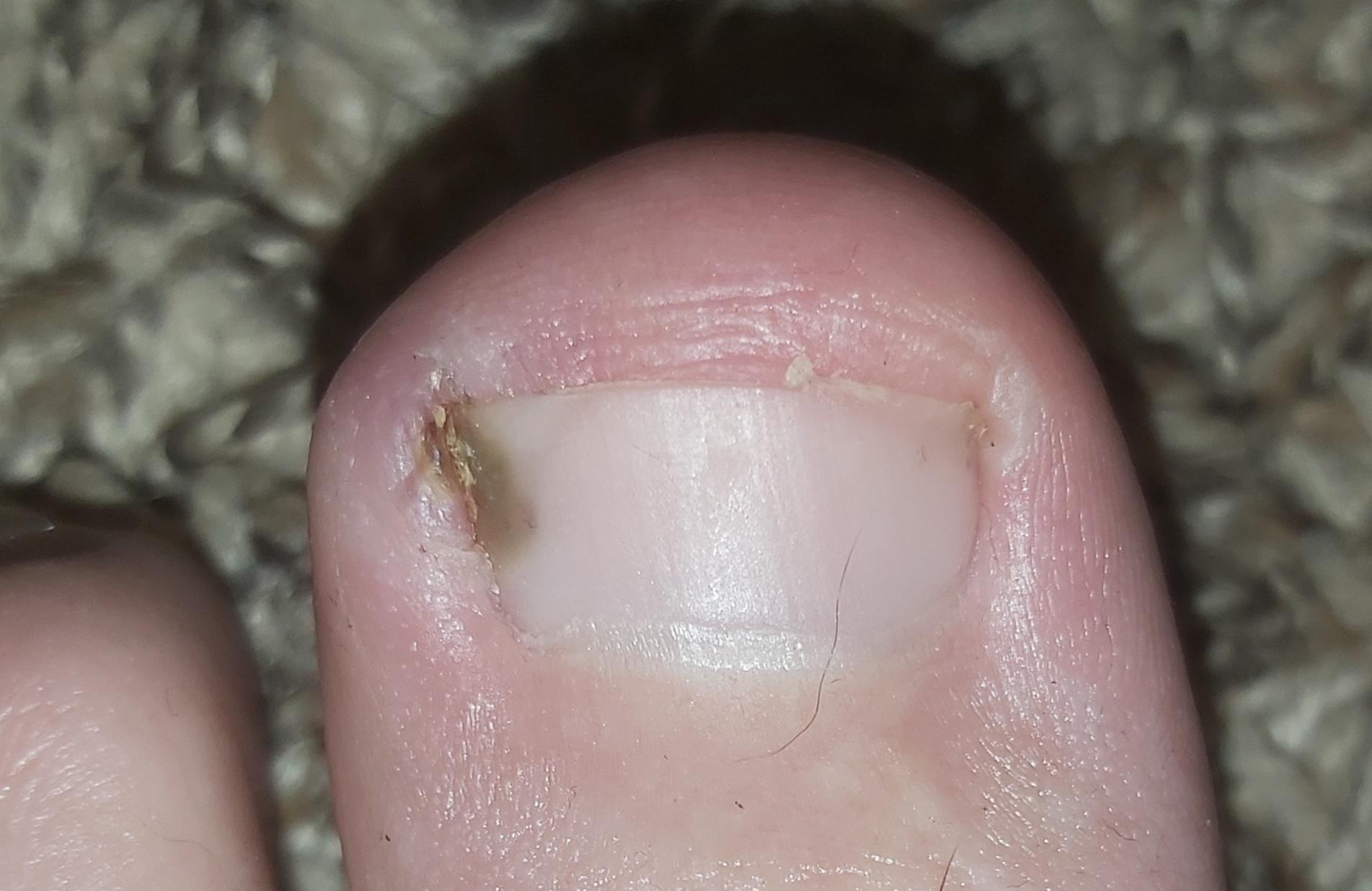 what is under my nail?? r/DermatologyQuestions