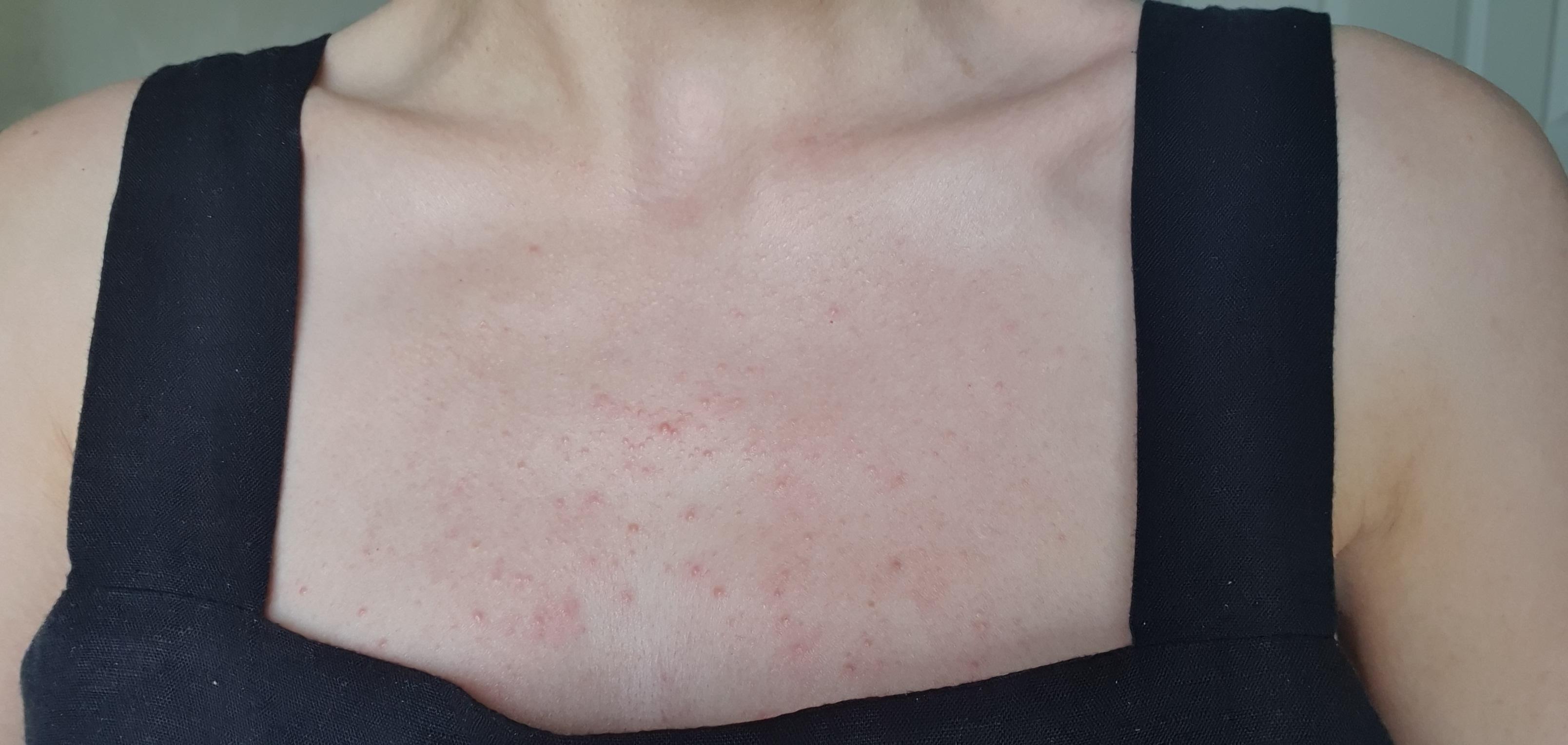 nothing helps with my chest acne acne