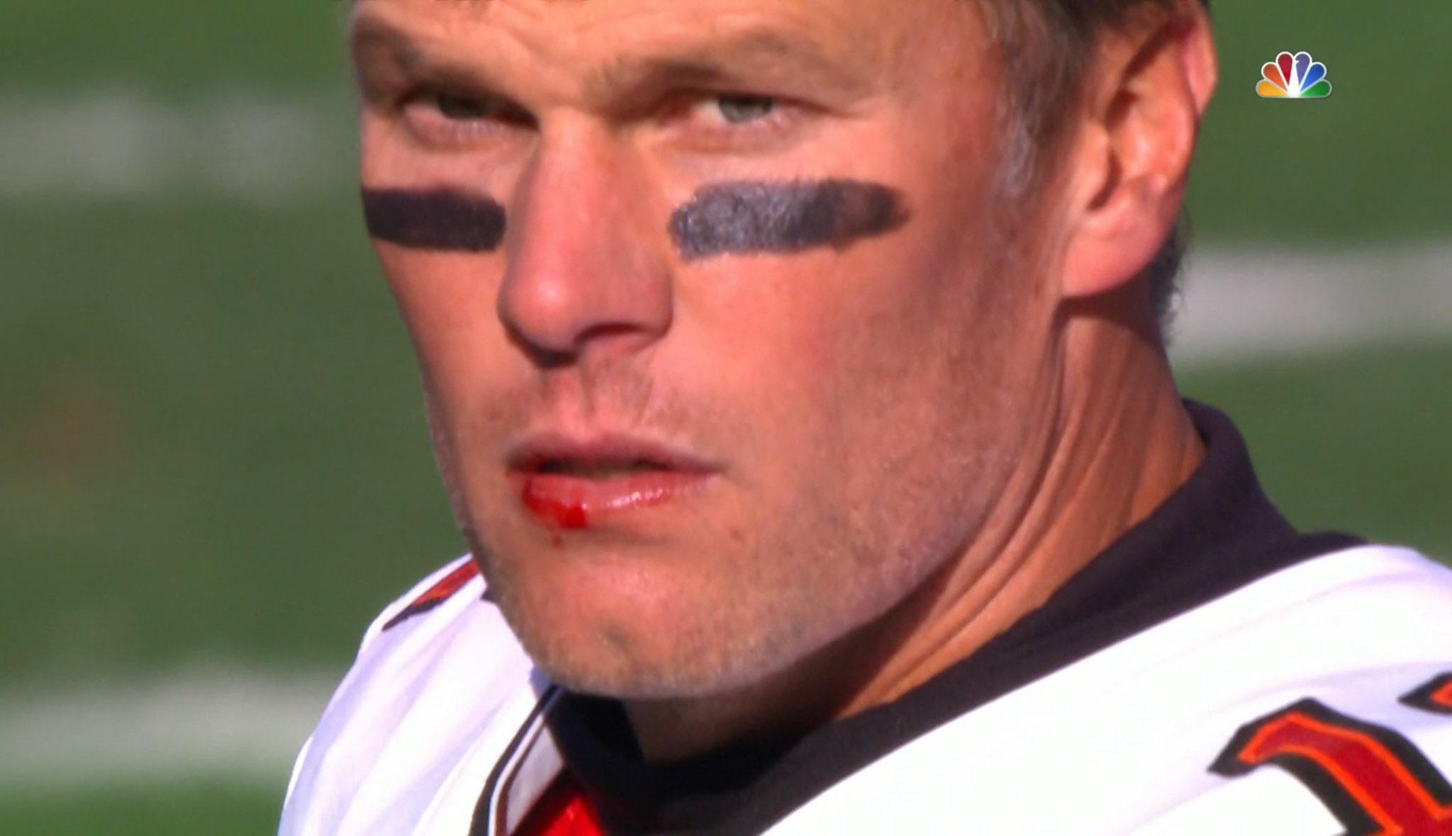 Tom Brady with a busted lip r/pics