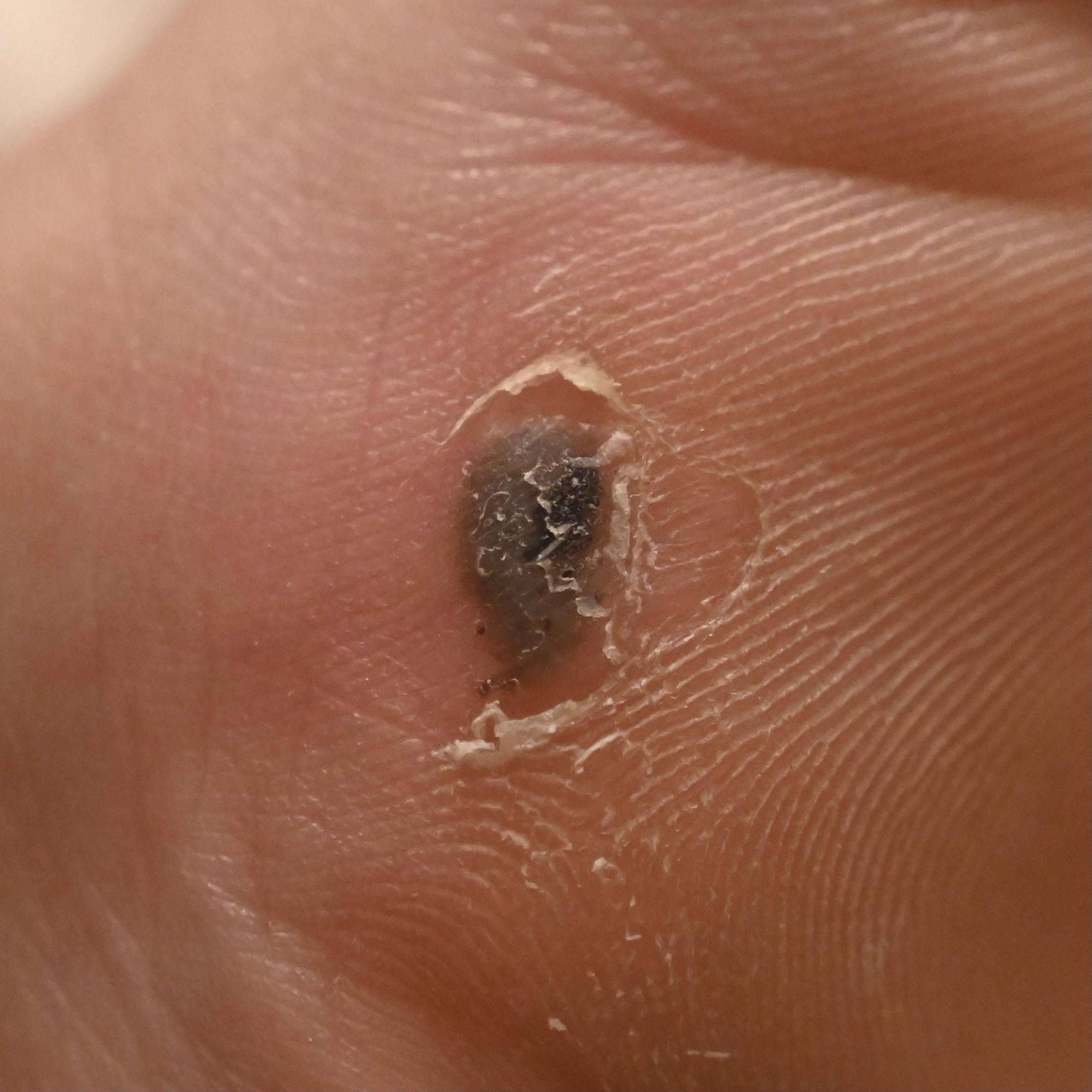 Is this melanoma or a scab? r/Melanoma