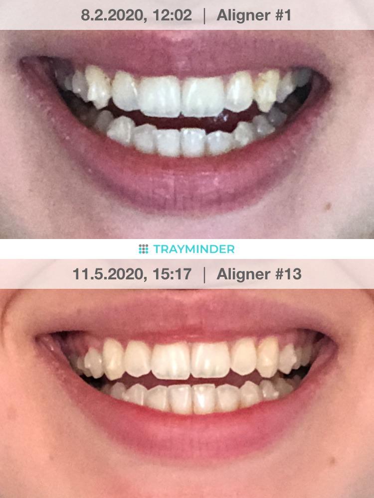 Change Invisalign Trays Every Week? The Healthy Mouth Project