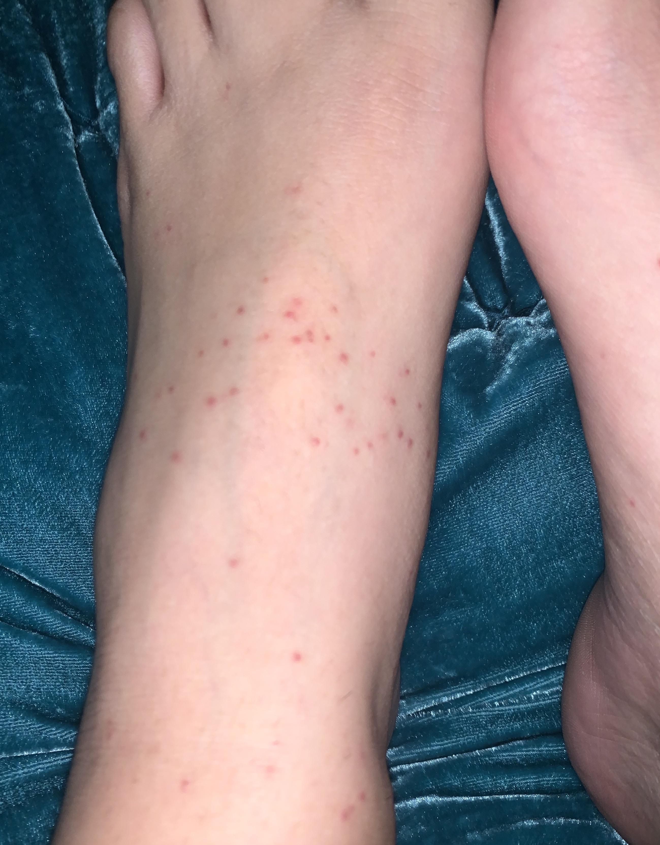 I have these red little bumps on both of my feet and I