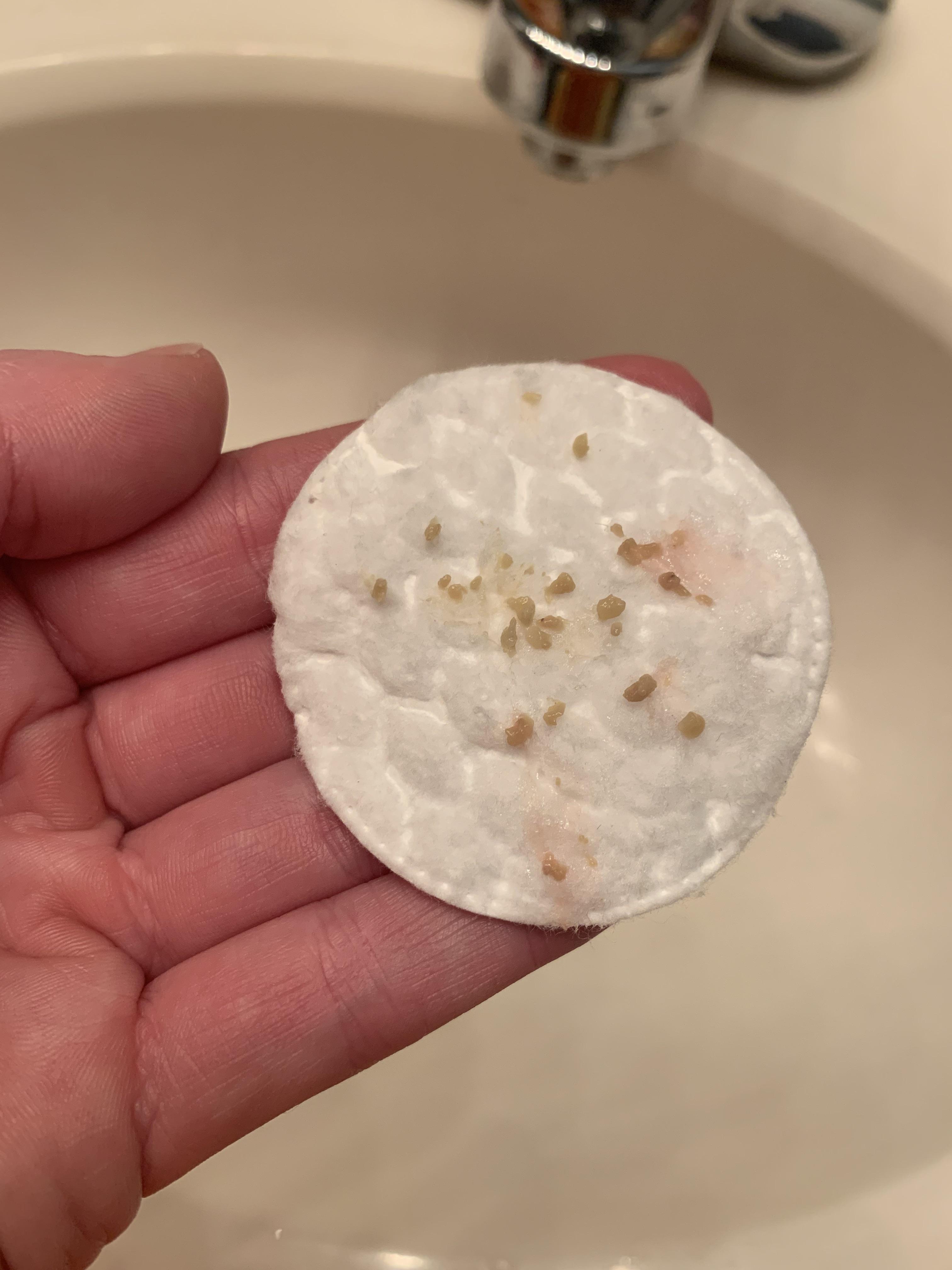 Left side, strong side. r/tonsilstones