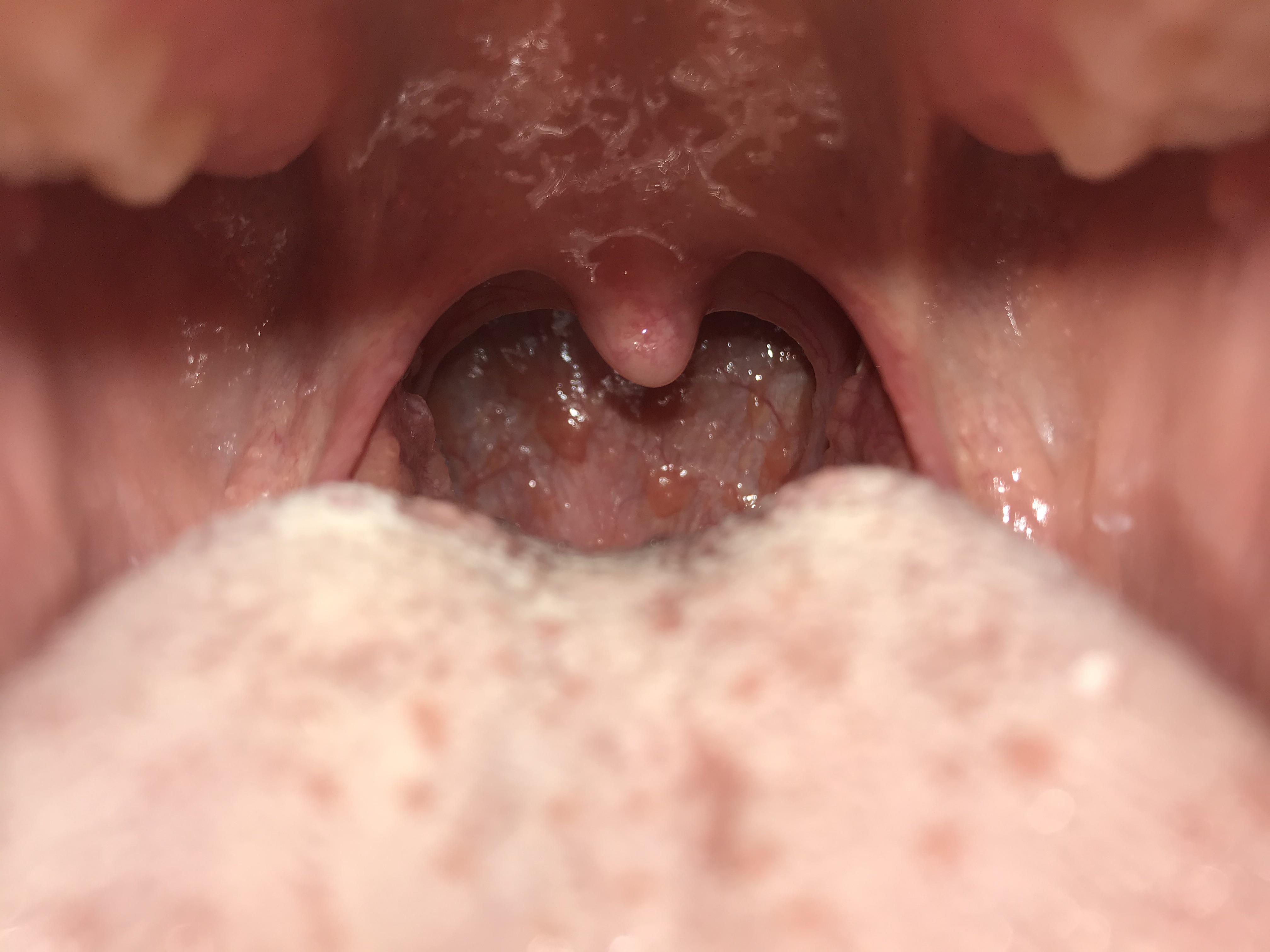 Bumps at the back of my throat ent