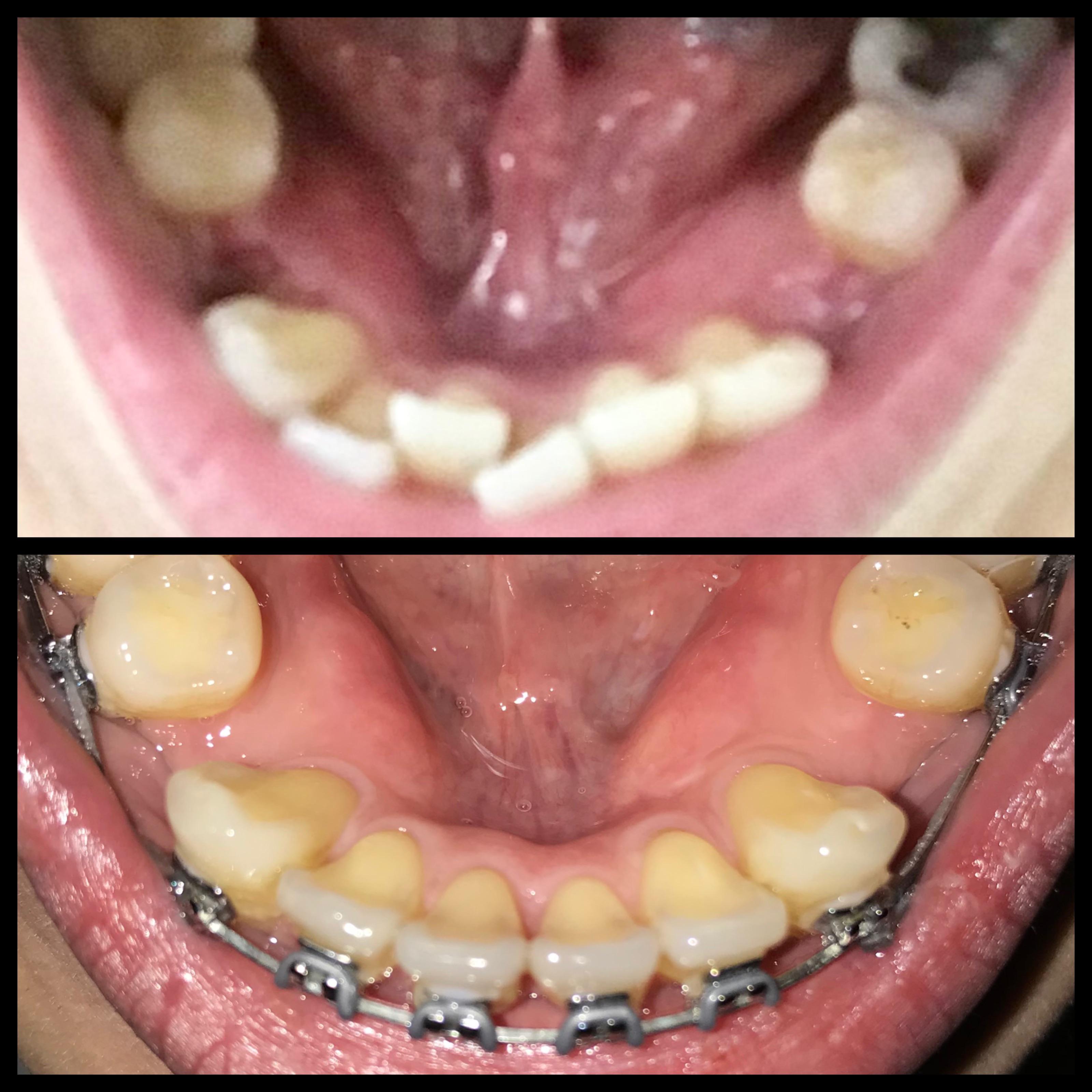 Took about 6 months for this progress. I still ponder if the 4 teeth