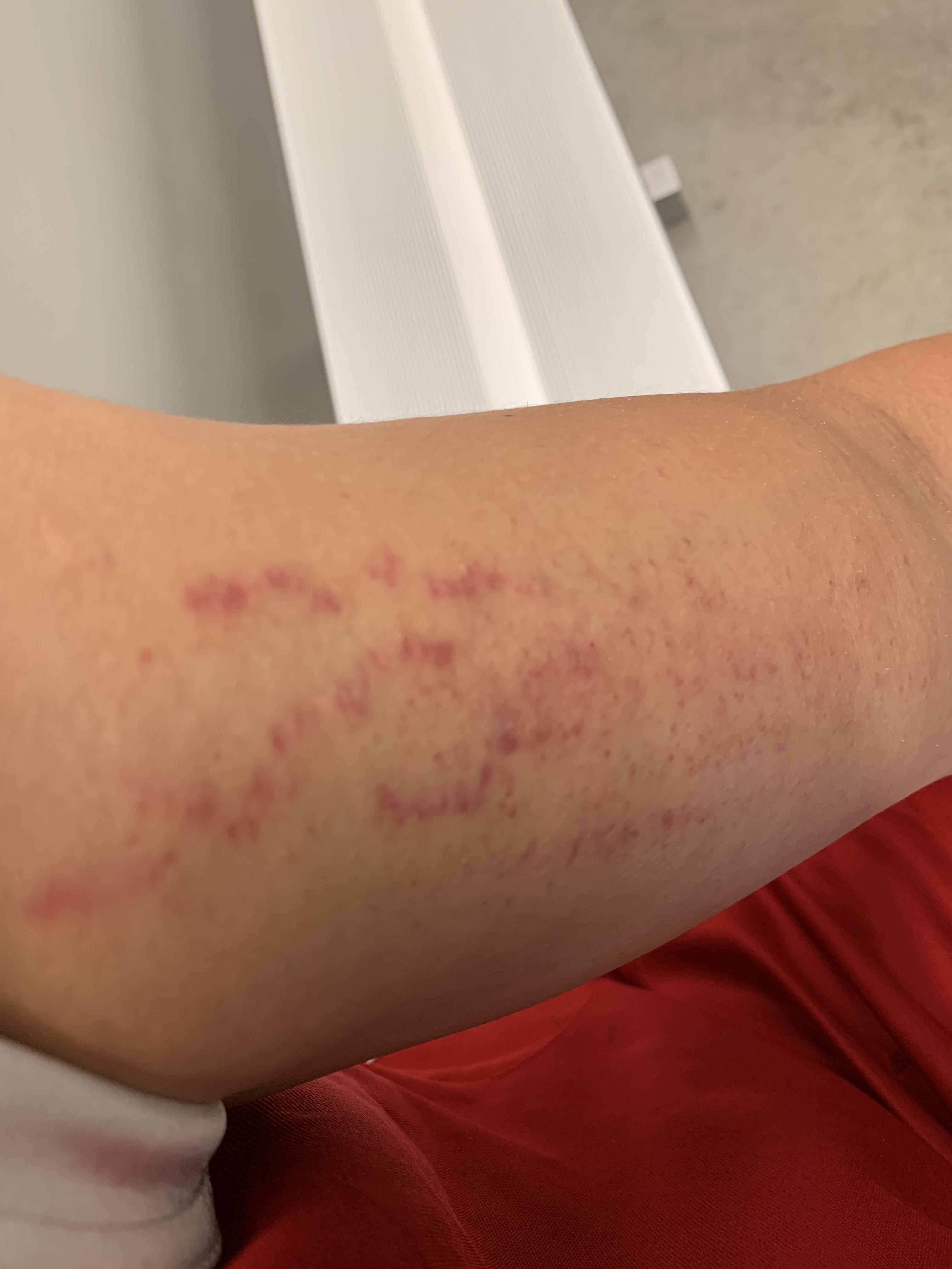 Are these stretch marks? Why are they so red? They’re not itchy and