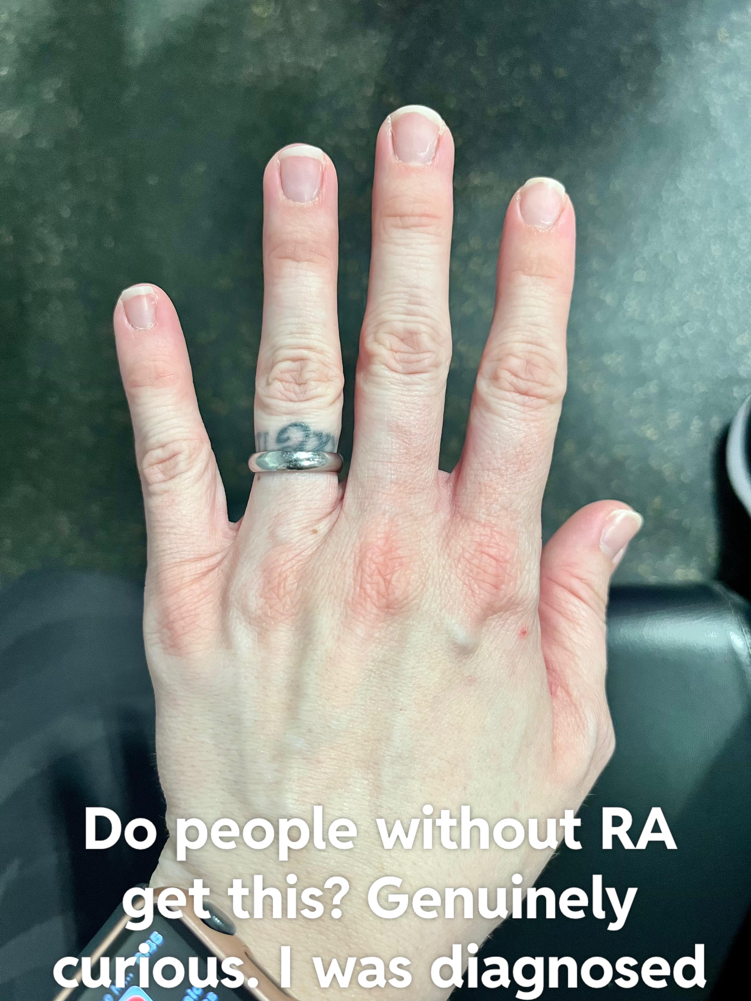 Red knuckles r/rheumatoid