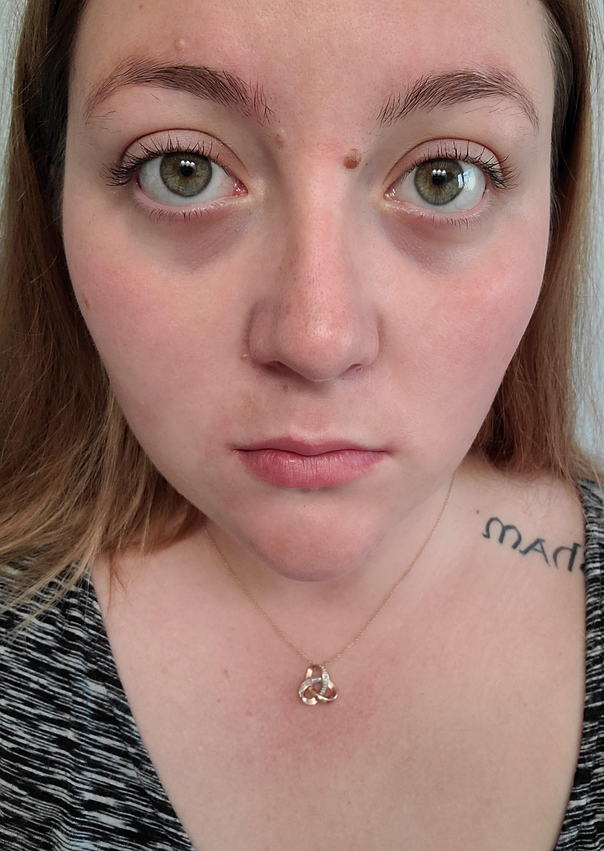 dark circles. What surgery gets rid of them? r/PlasticSurgery
