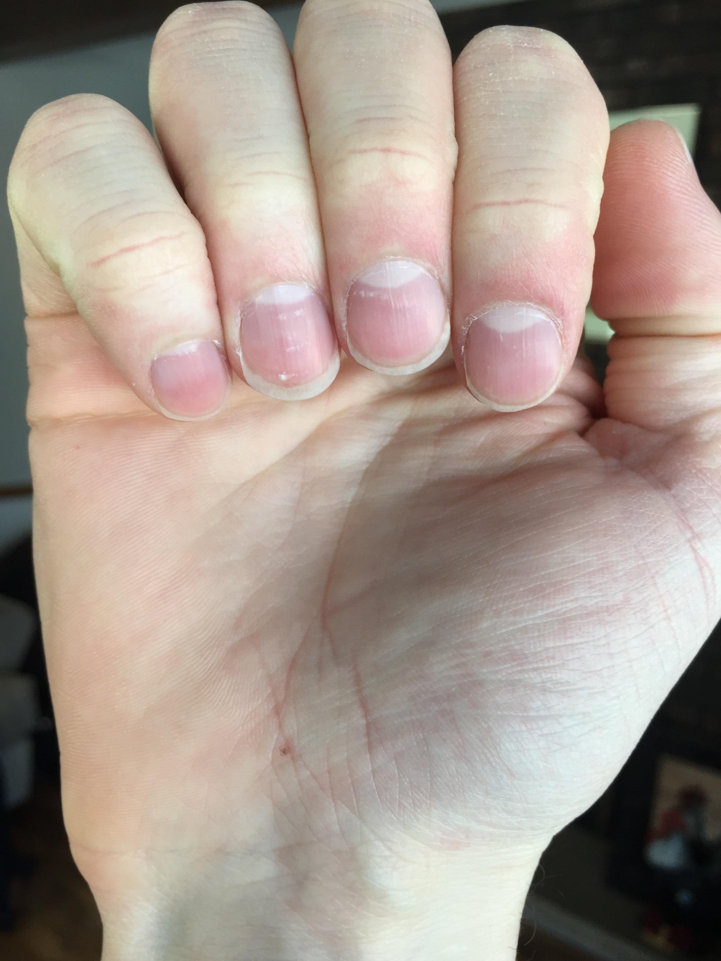 Saw the other post about pencil lead stuck for years. Mine is at the middle bottom of my palm