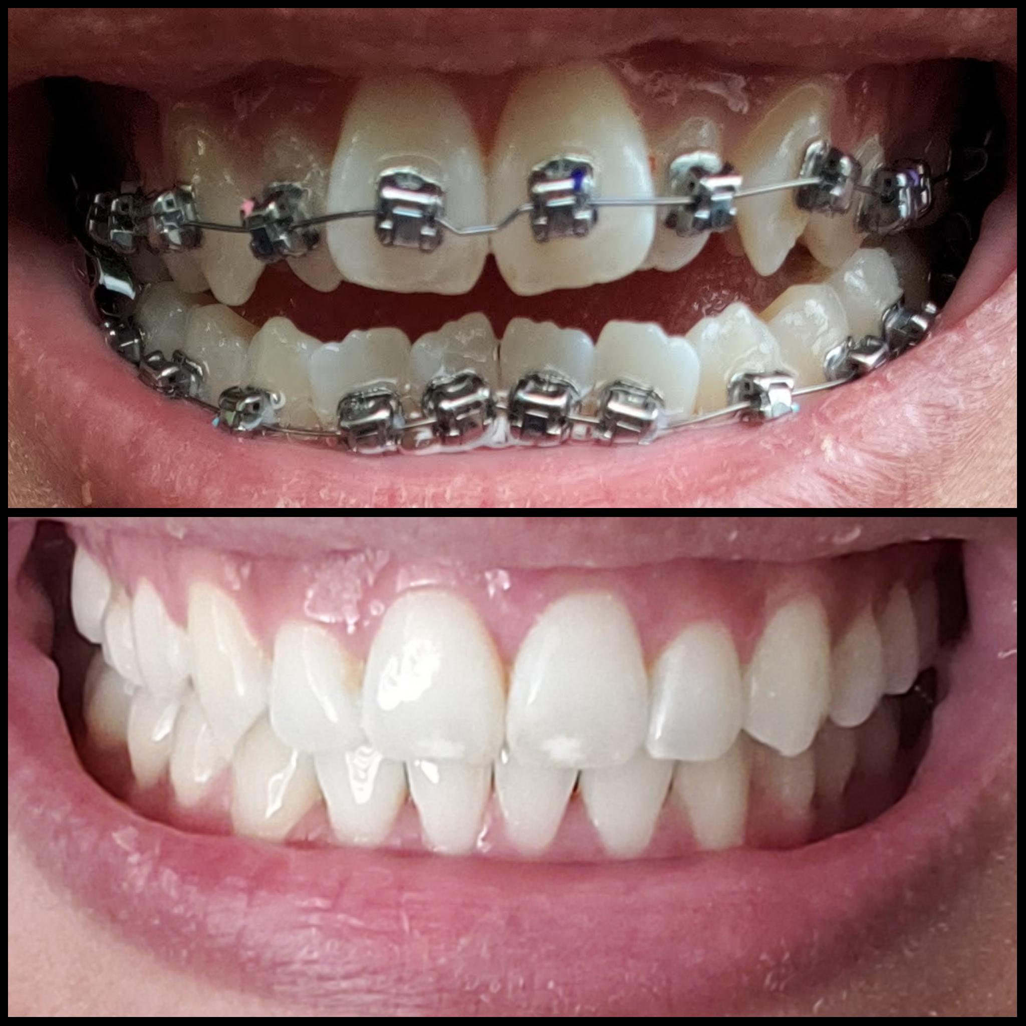 Two Years of Damon Braces Worth It! braces