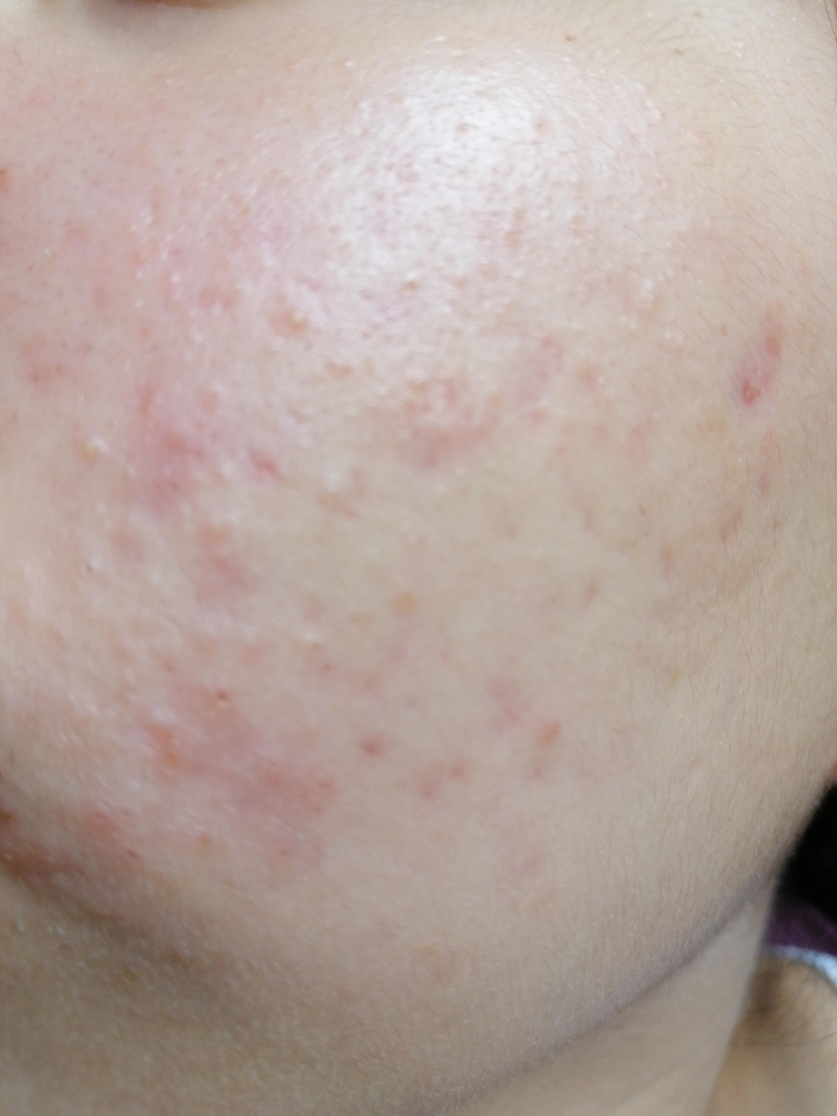 I used to have oily and acne prone skin since I was a teenager, now my