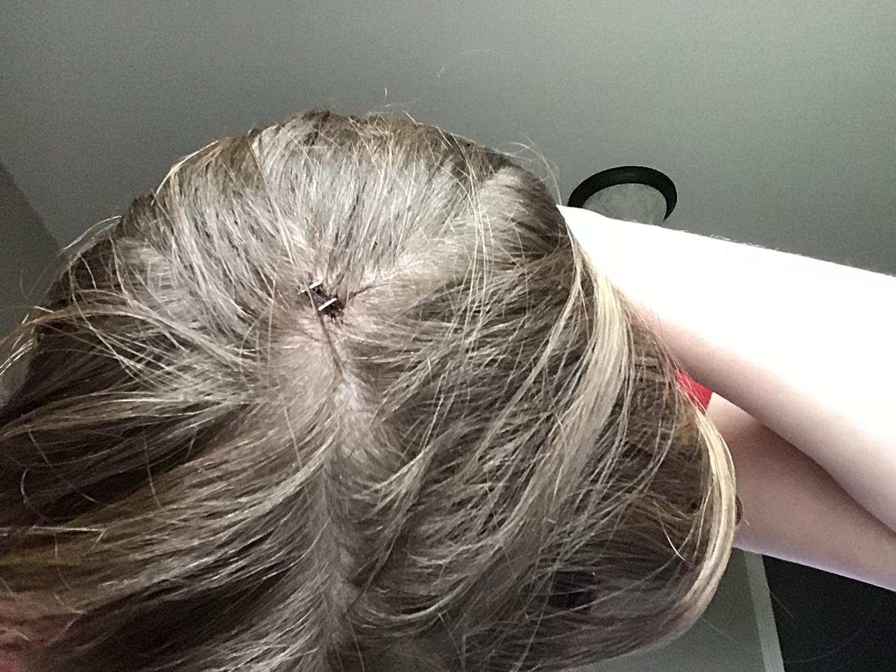 cracked my head open, had to go to the ER and get 2 staples r/scars