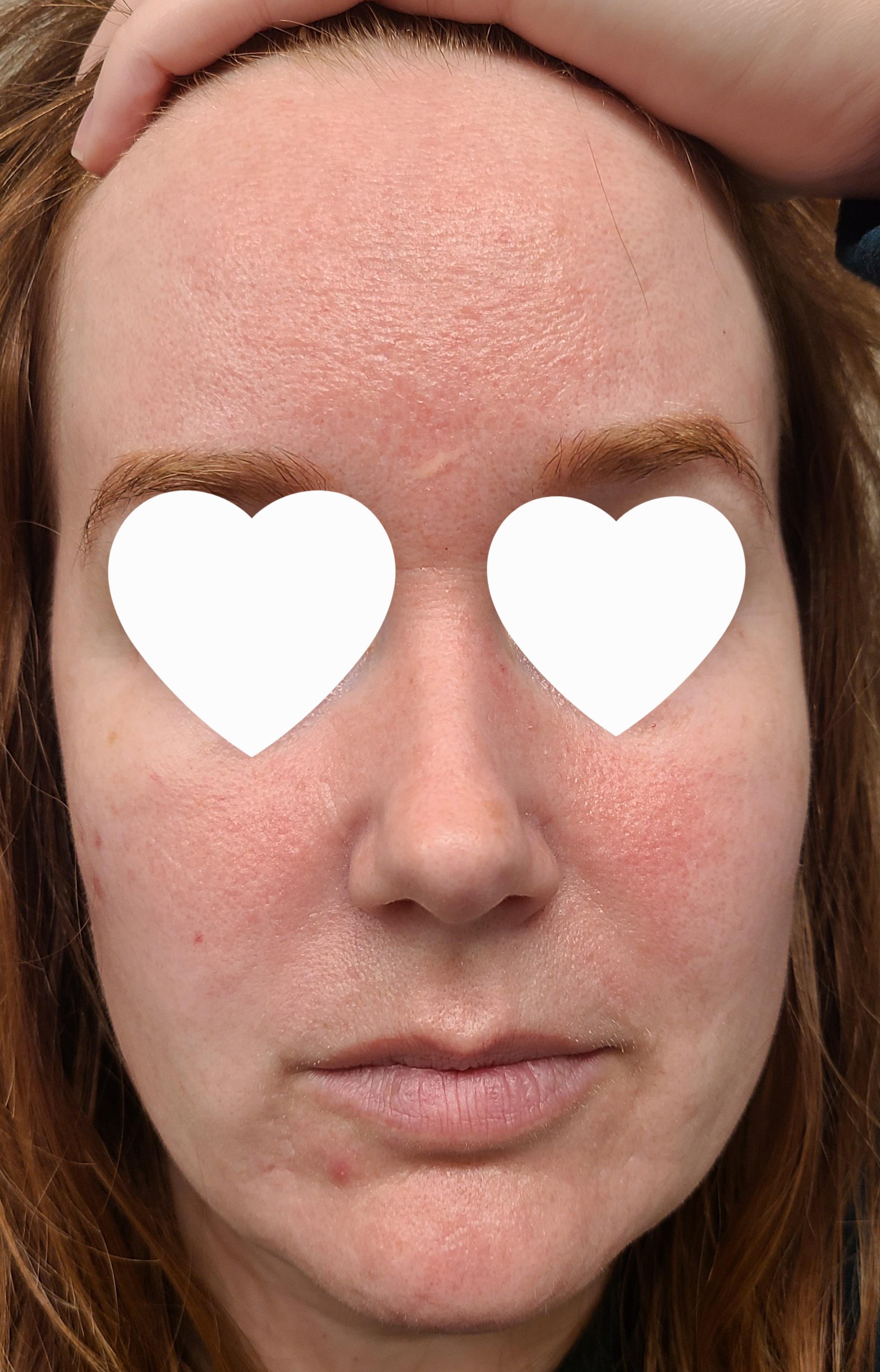 Why do I always look sunburned? r/30PlusSkinCare