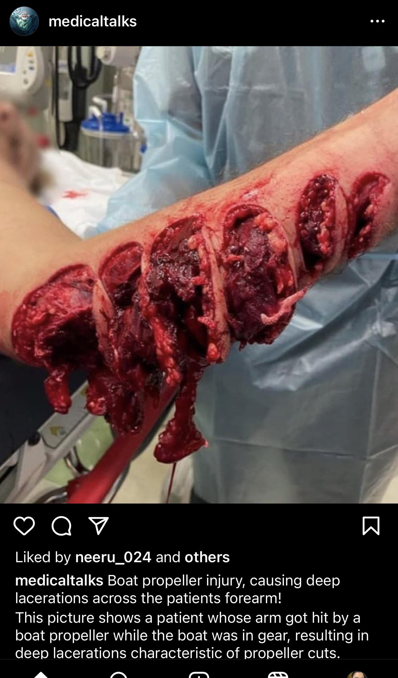 Boat propeller injury r/MedicalGore