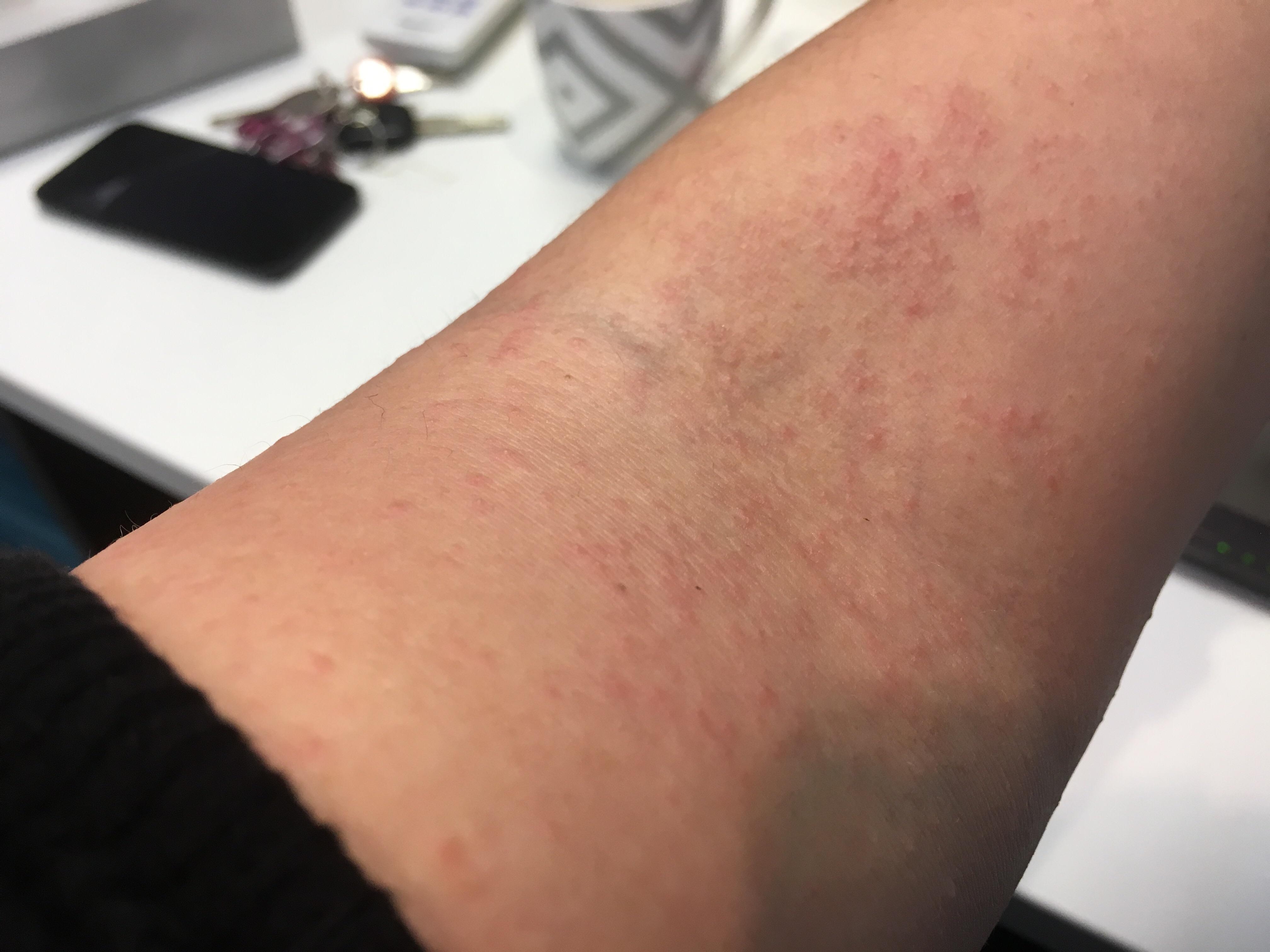 My gluten rash.... Celiac