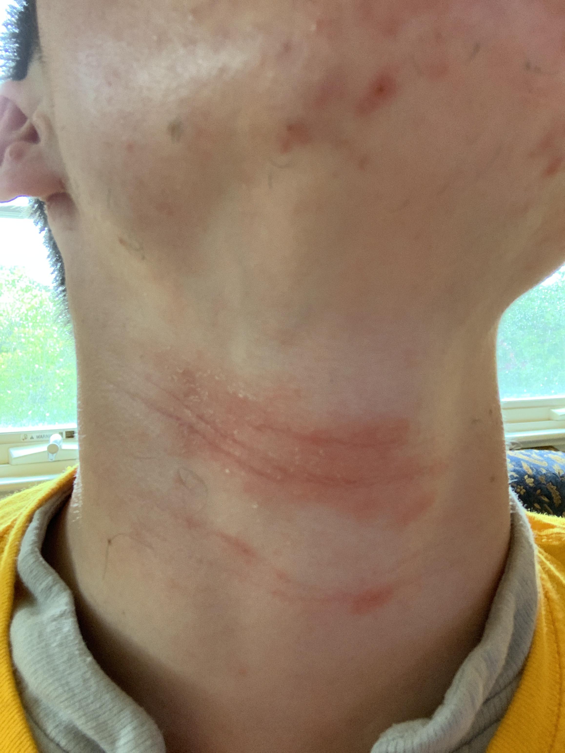 Large red rash on my neck r/Accutane