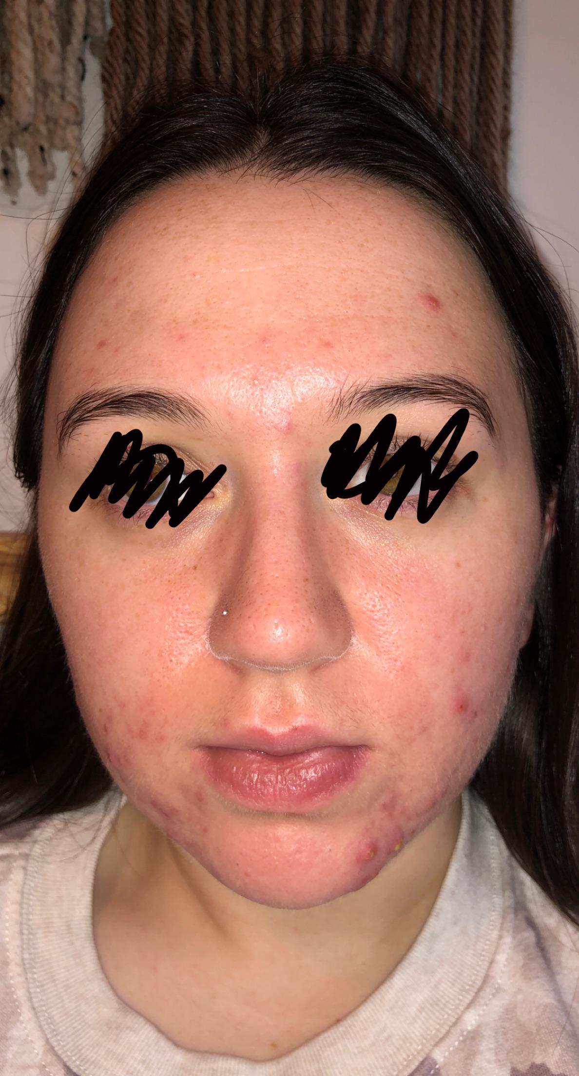 lip balm review....can you tell i'm on accutane? Accutane