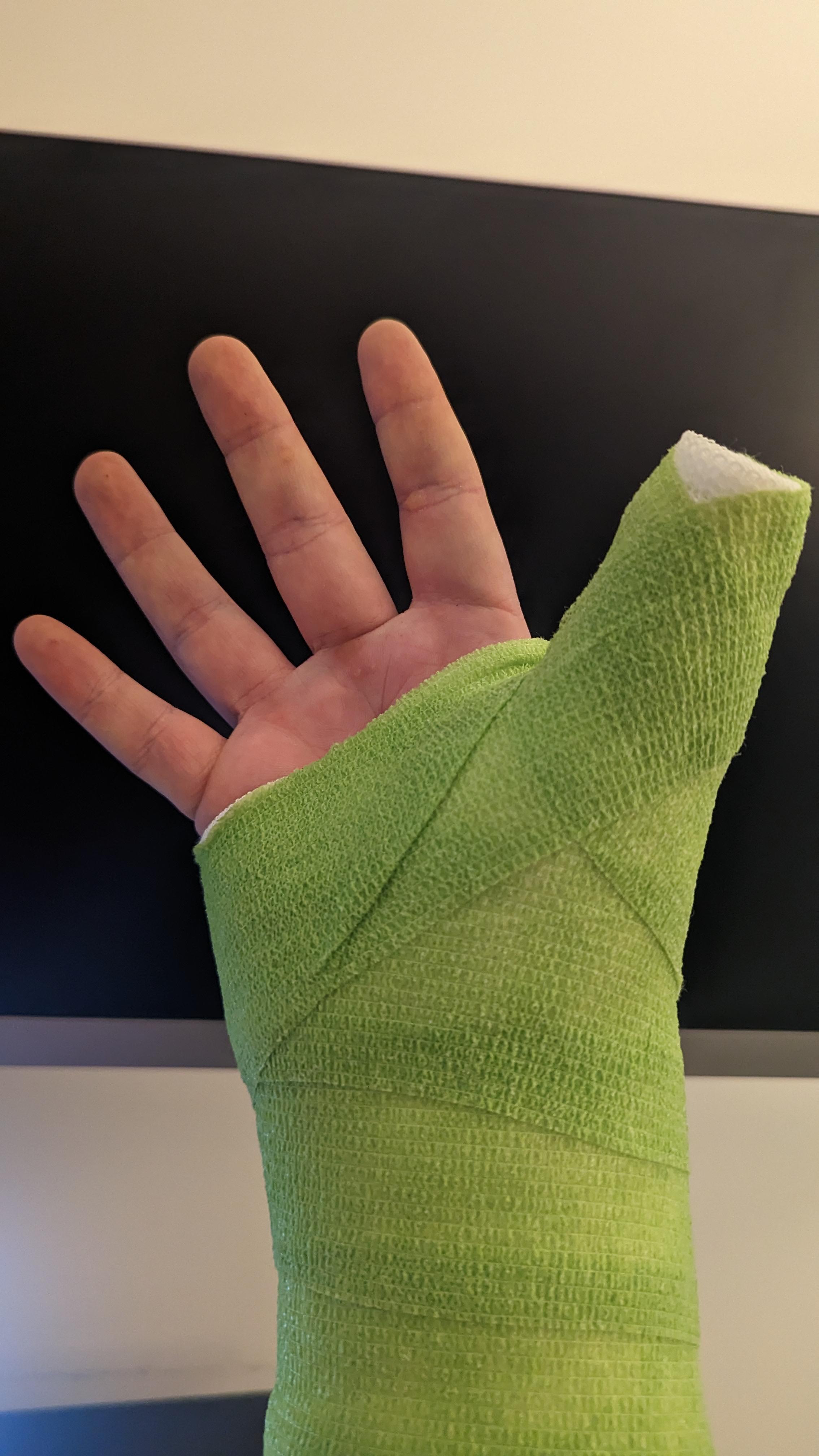 Broken Hand Cast