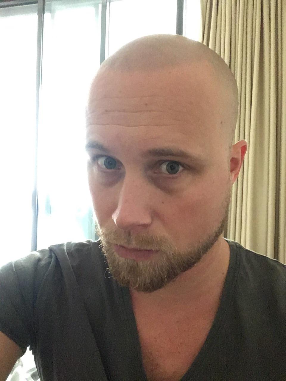 Dark Circles Under Eyes Before And After Men