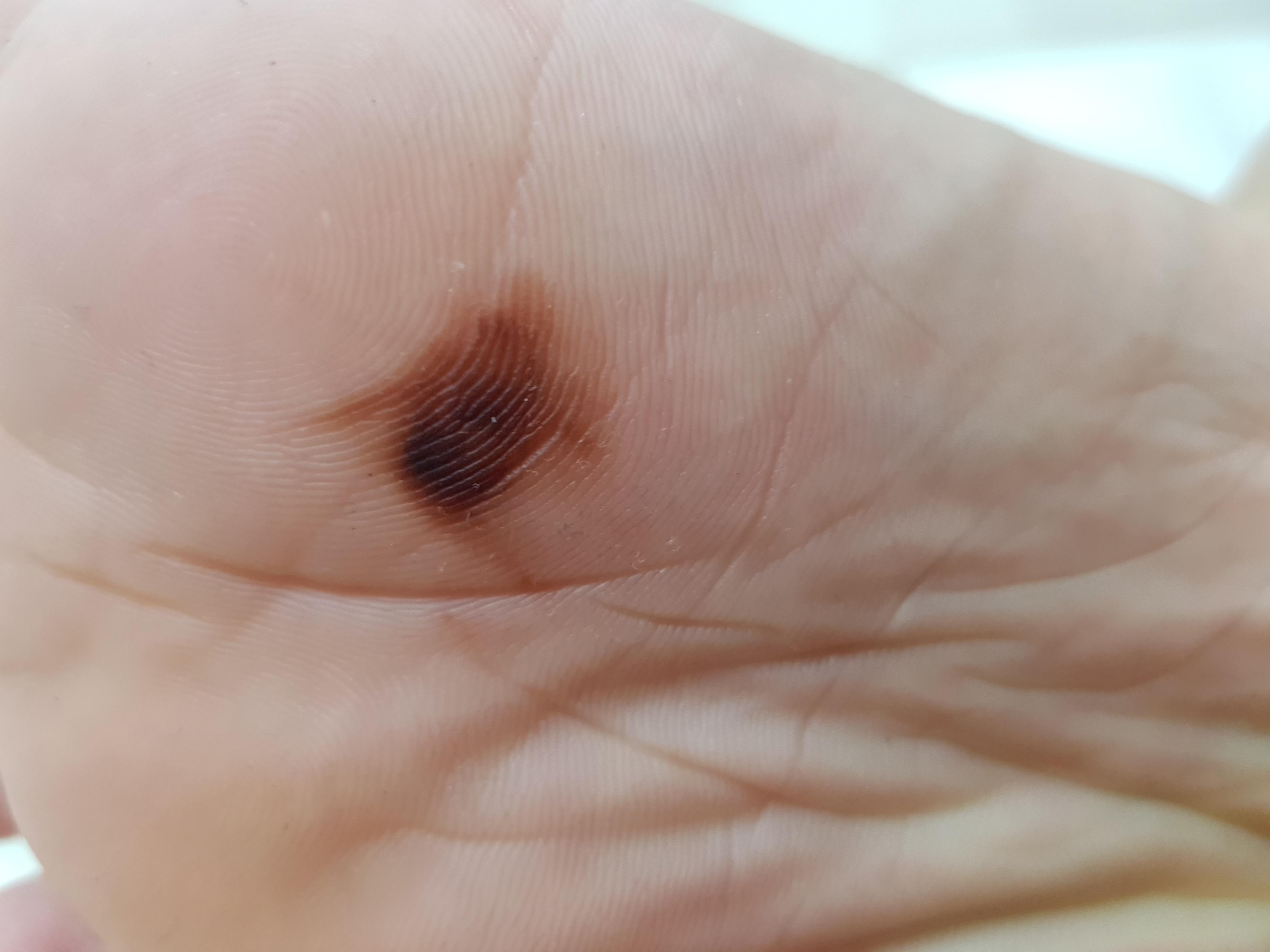 Just found out this under my foot , is this melanoma? r/Melanoma