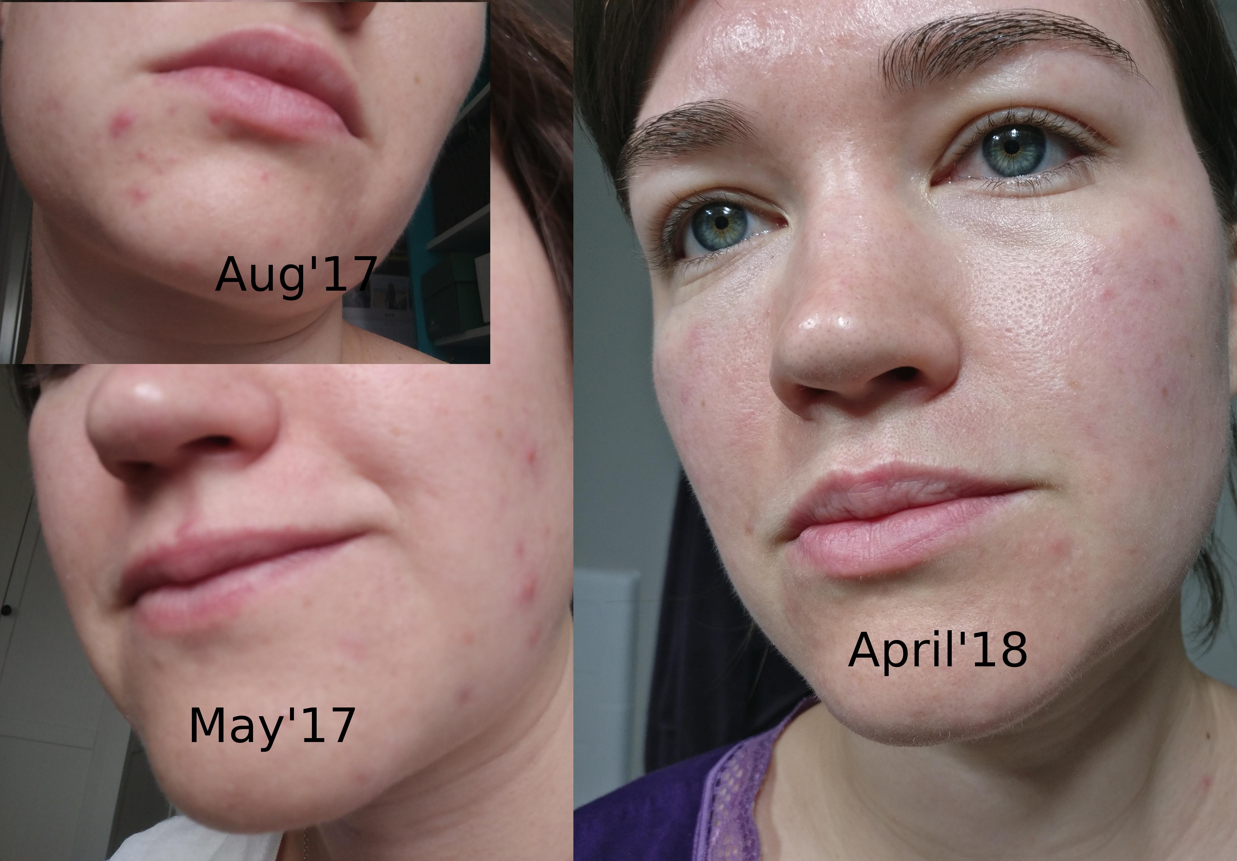 [B&A] [Skin Concerns] How I treated my nonfungal acne with antifungal