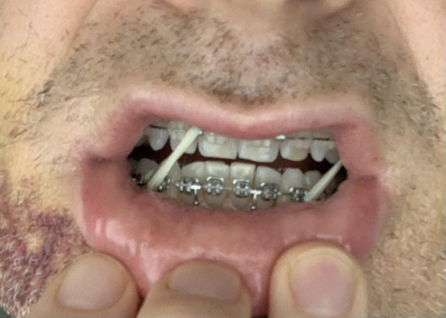 Postop asymmetry, elastics & TMJ pain (see comment) r/jawsurgery