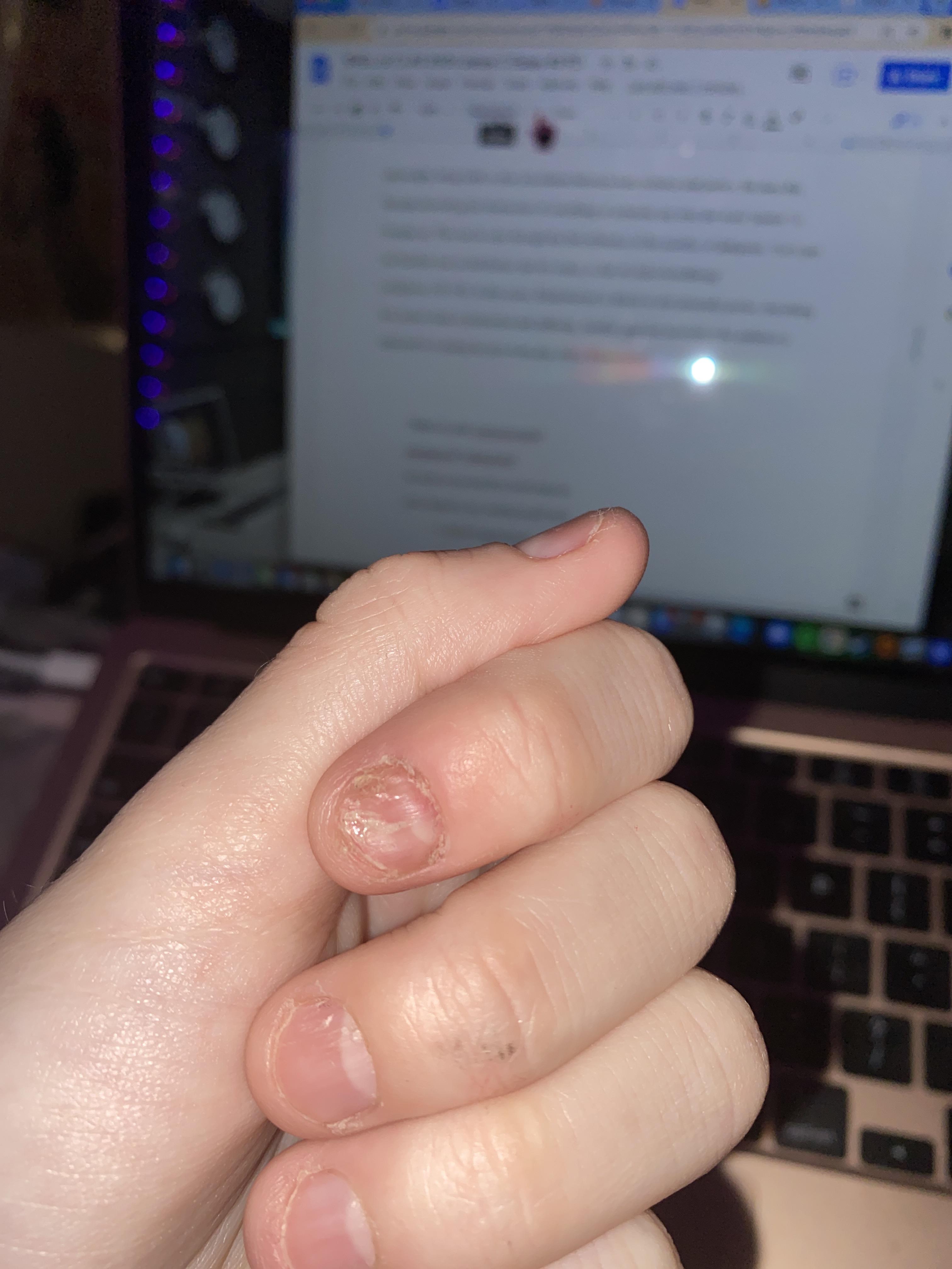 2 years ago an acrylic nail ripped off my real nail on accident