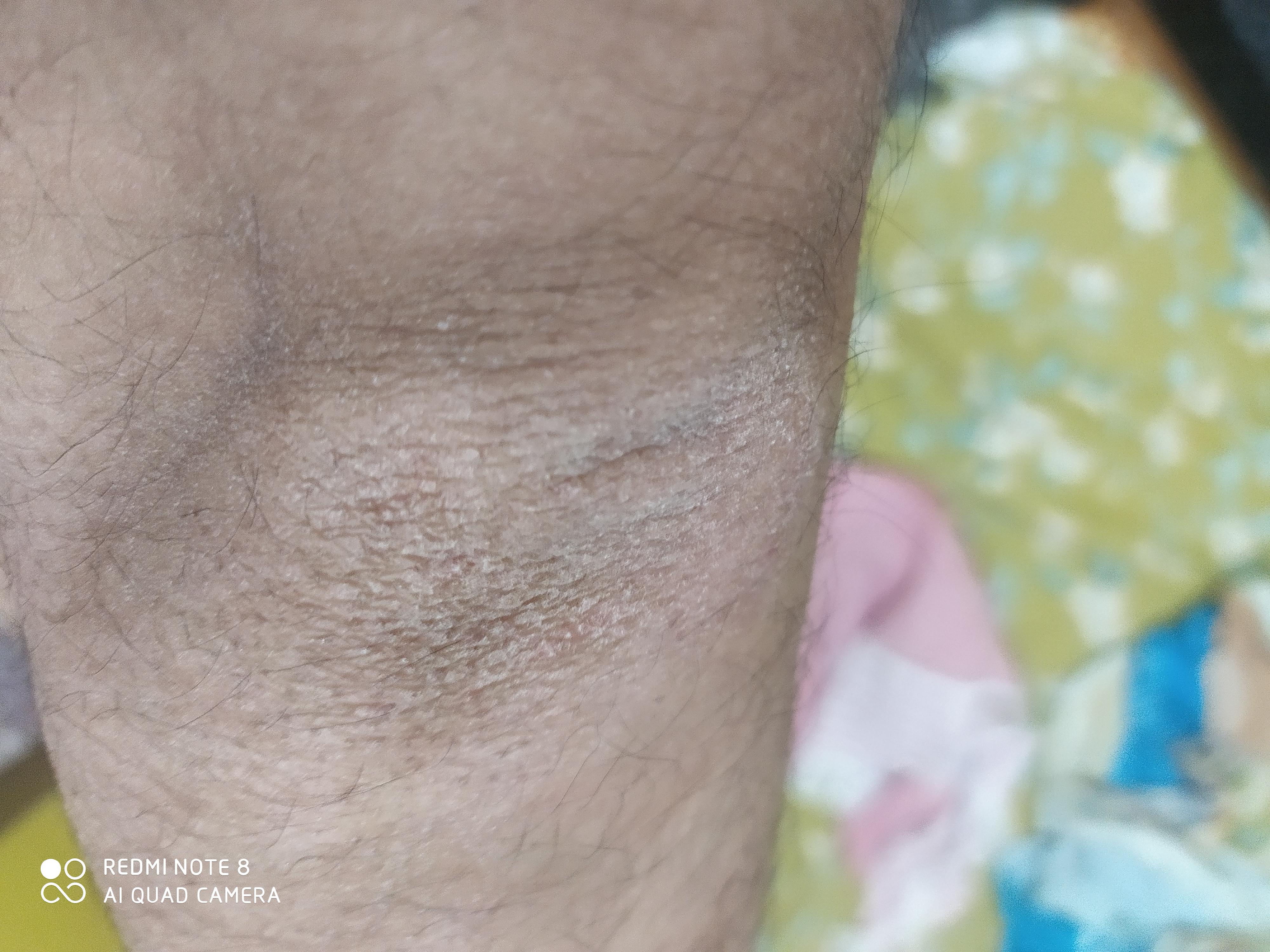 Can somebody tell what this is?? I have it on both my elbows and my