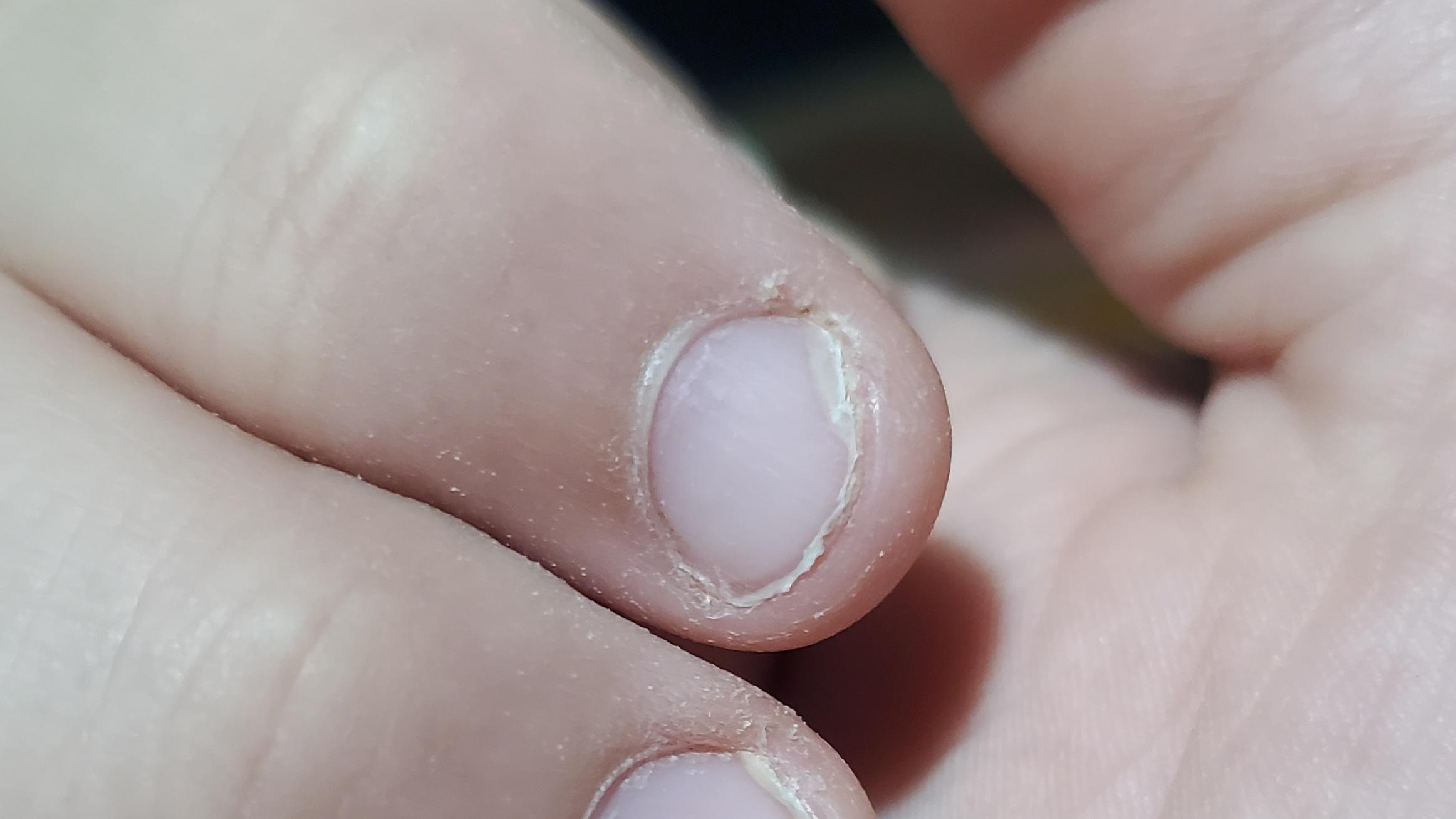 Relapse. The "dead nail" looks like its reattaching quite quickly, so i