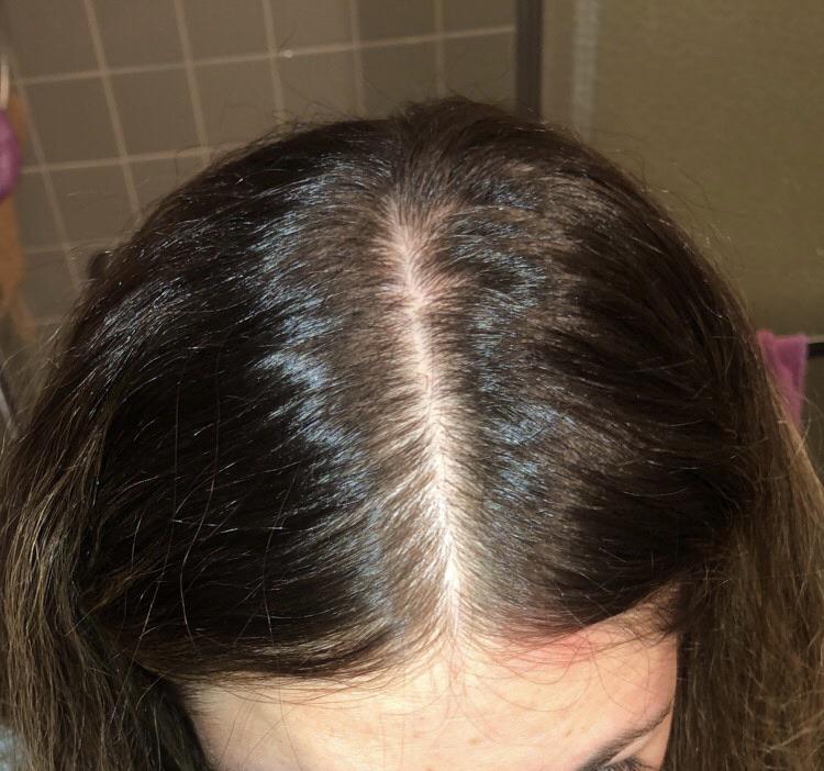 Stage/level of severity? I’ve had AGA for two years. Lost a TON of