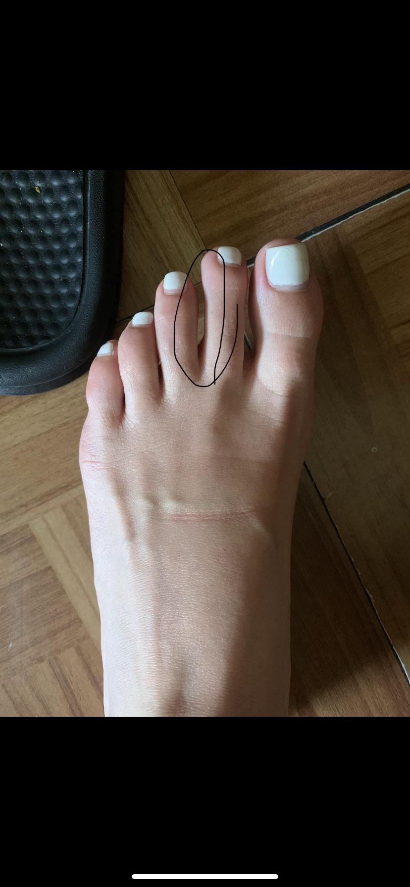 Pretty sure this is a plantar plate tear but no pain. Have you guys