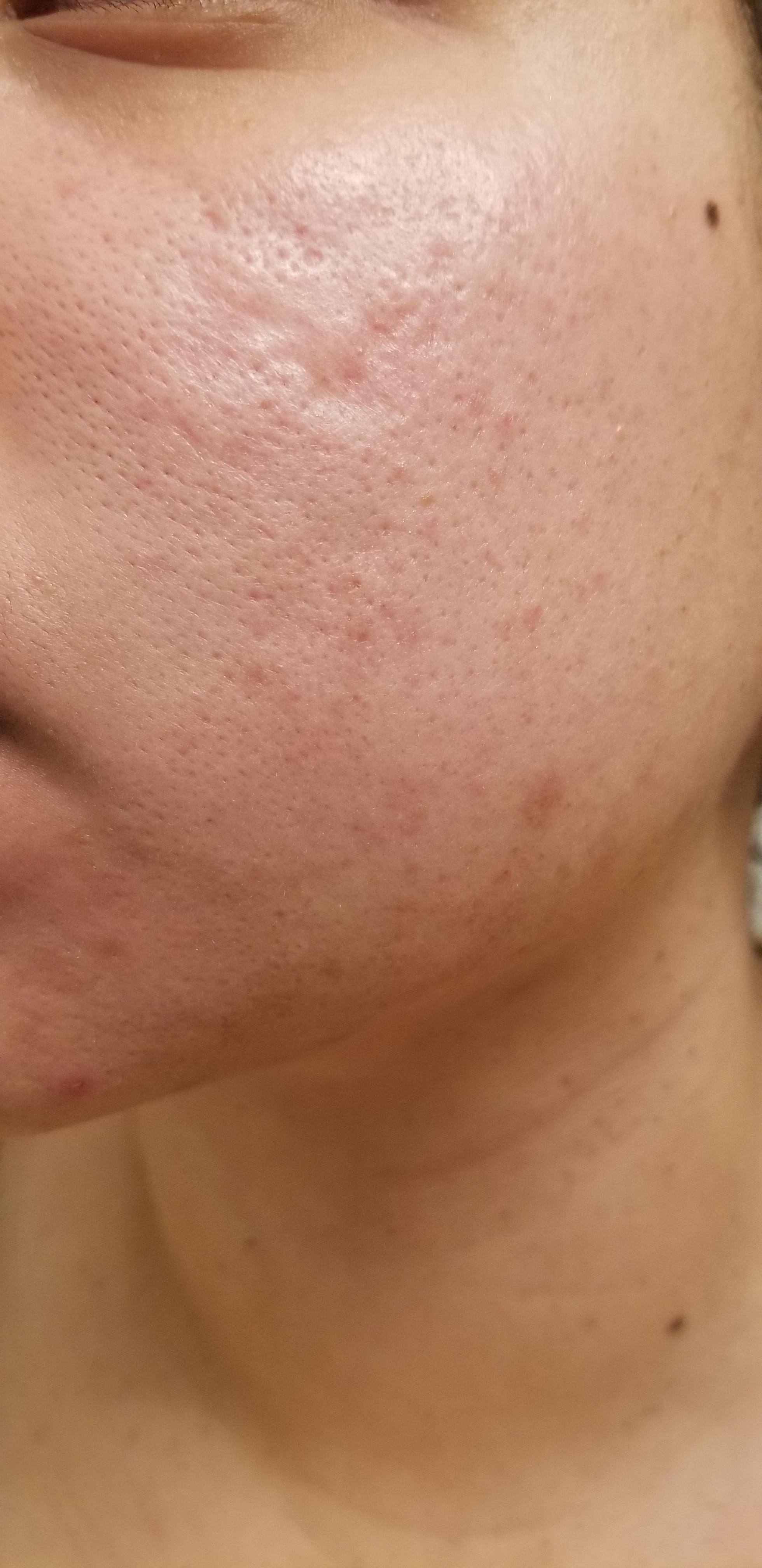 Large Pores And Scars Unfortunately, large pores are a common concern