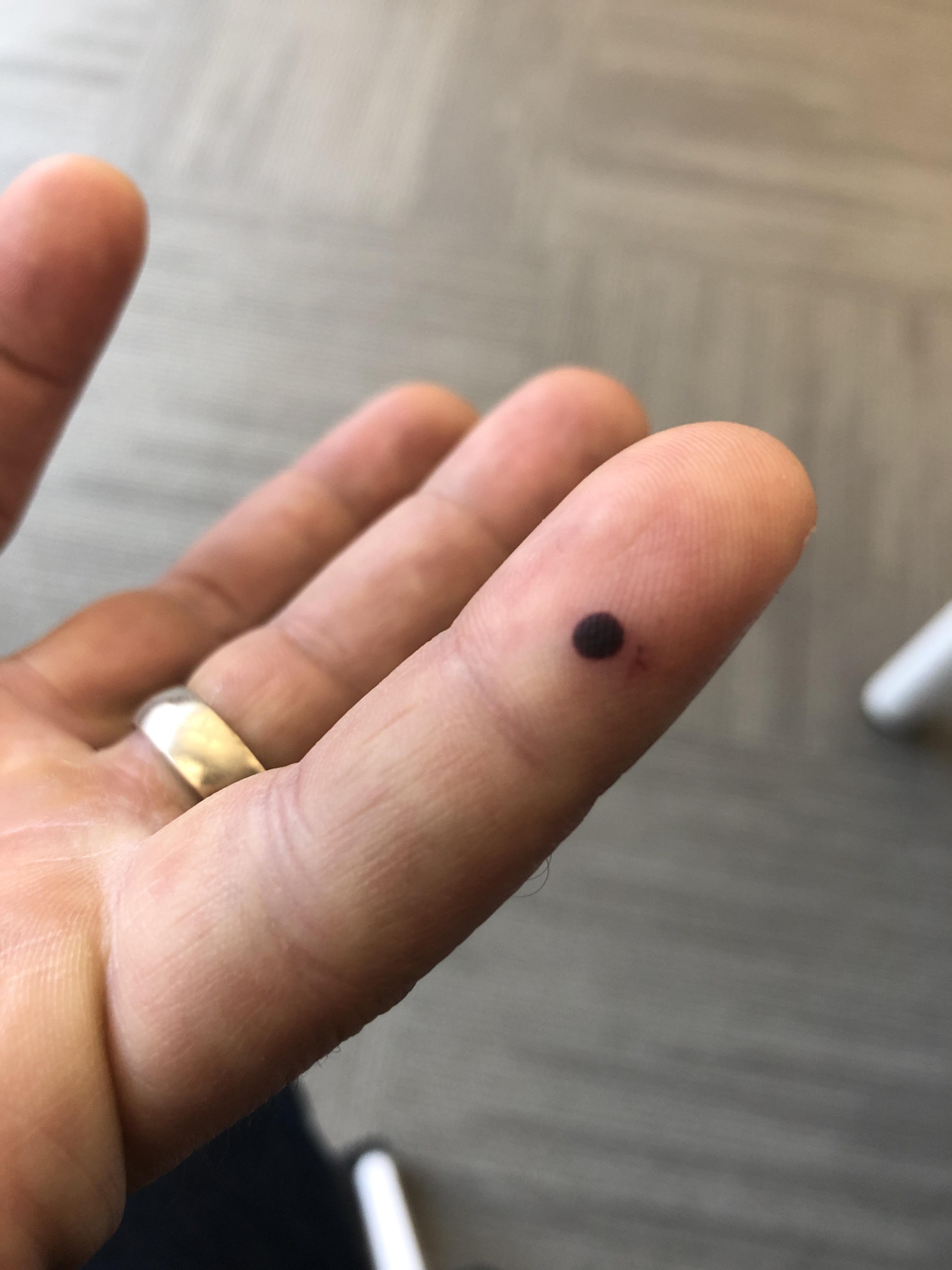 My perfectly round blood blister r/mildlyinteresting