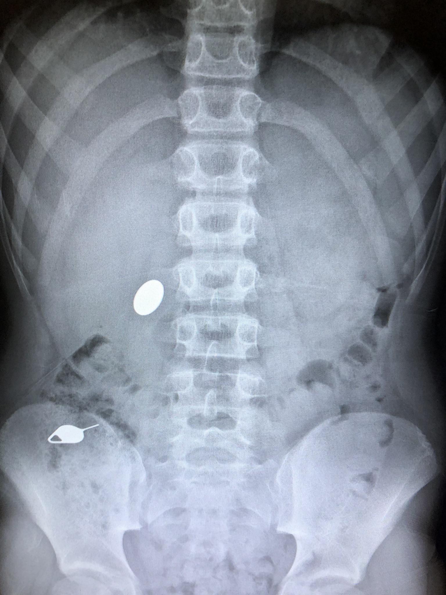 My kid swallowed a penny while showing his little brother how he accidentally swallowed a simm