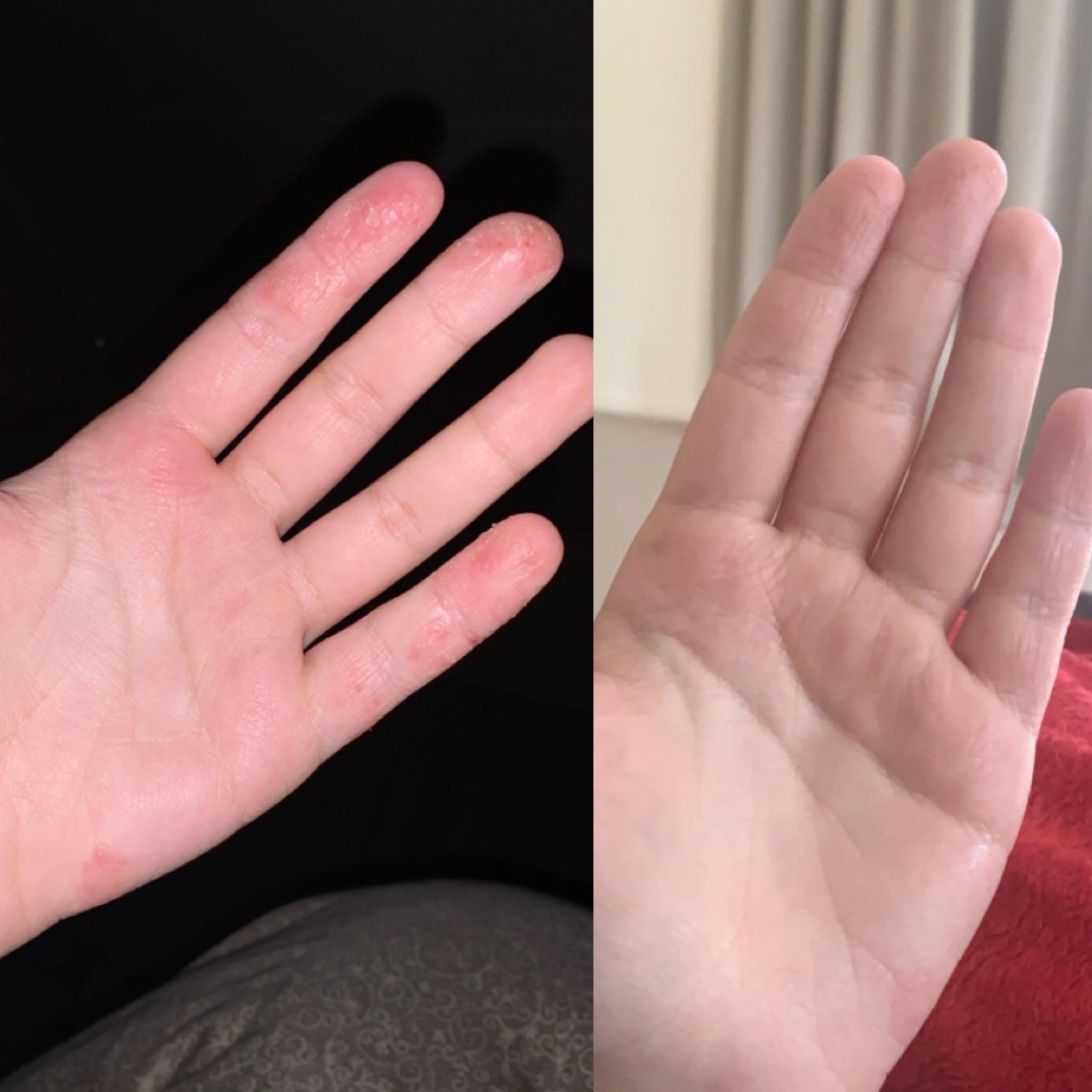Dyshidrosis on the up! (1 week of treatment) r/Dyshidrosis