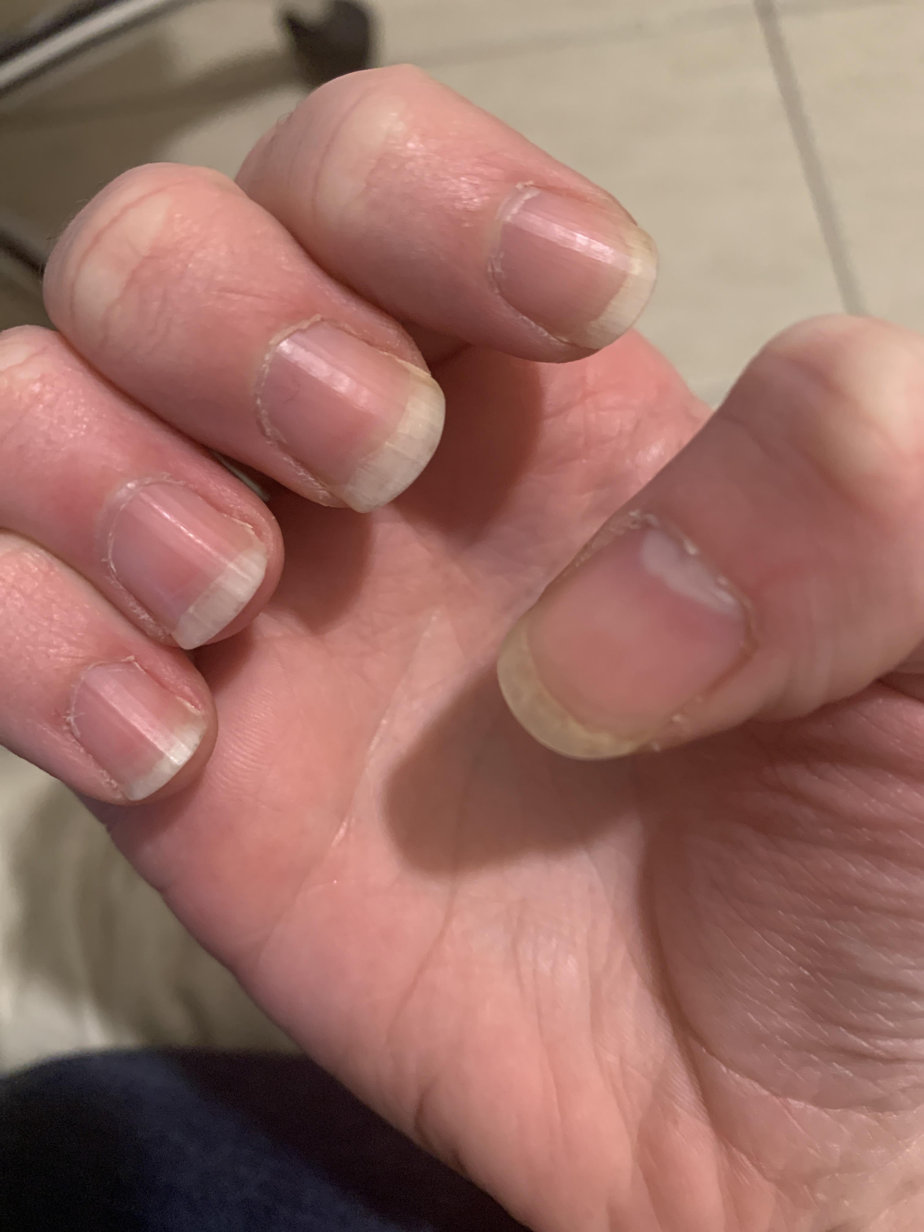 I stopped biting at least three years ago, but my nail beds never grew
