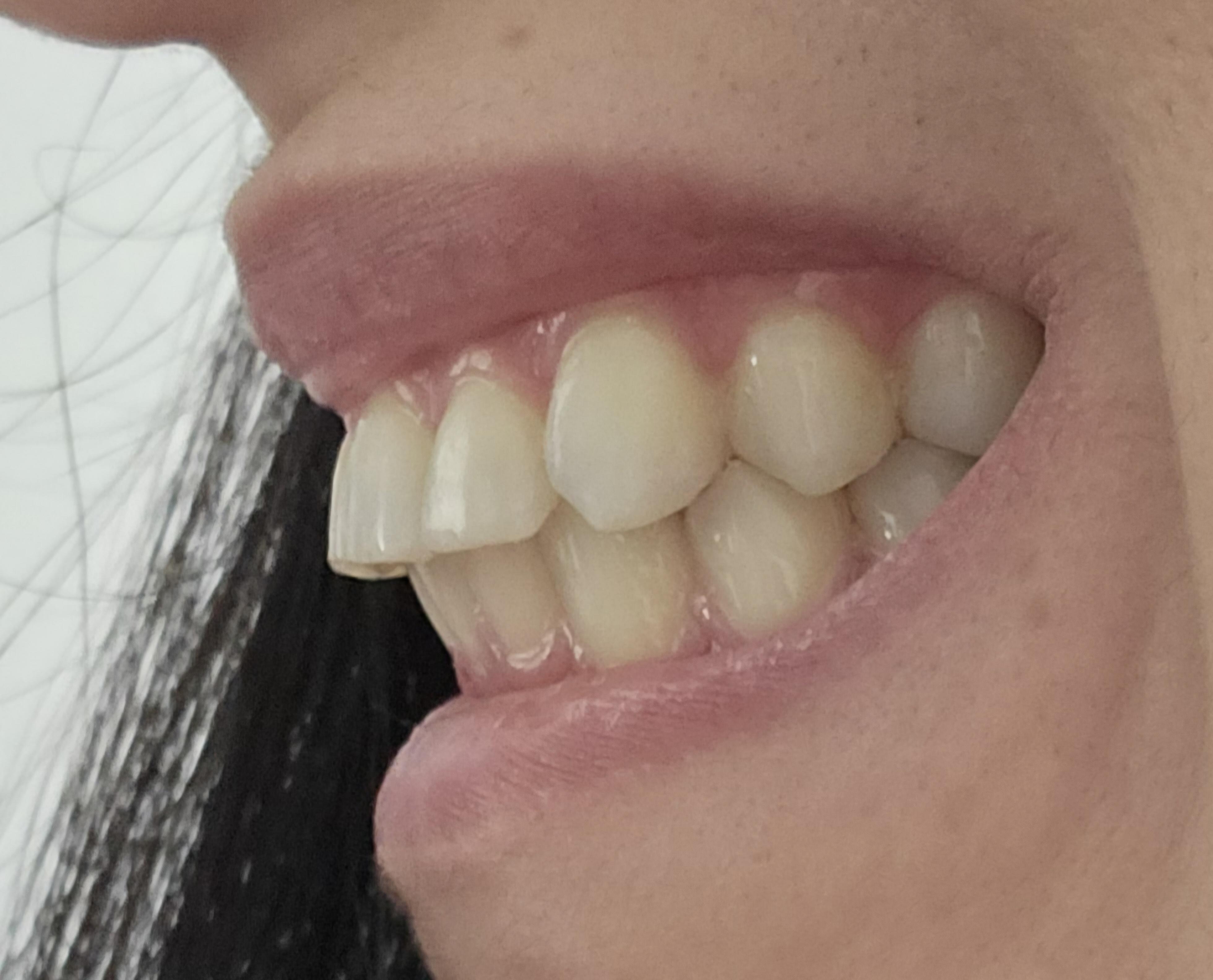 Flared teeth after braces r/braces