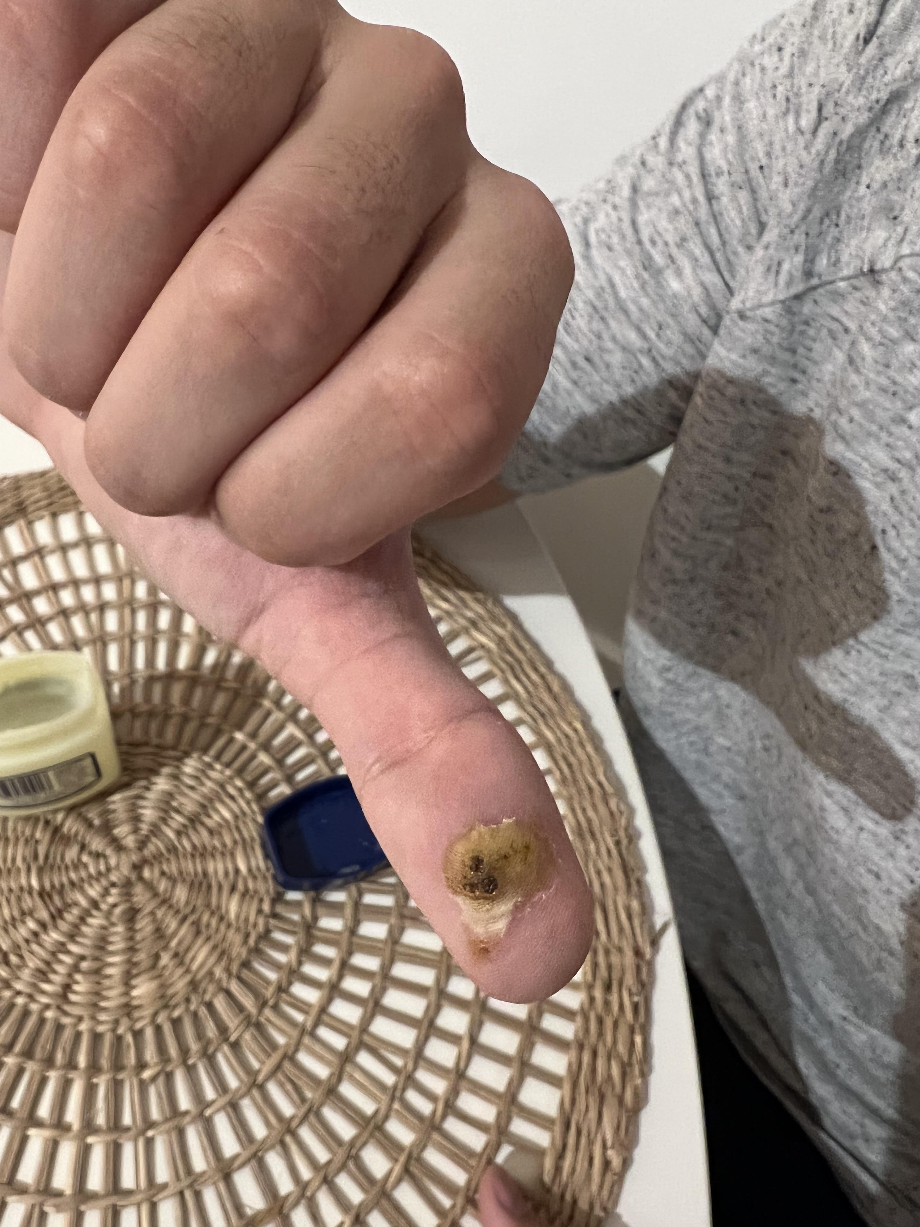 8 days down of Salicylic Acid treatment on what I suspected to be a