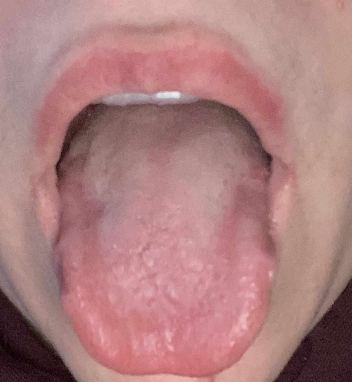 Retainer hurts a lot especially my tongue and the top retainer has made