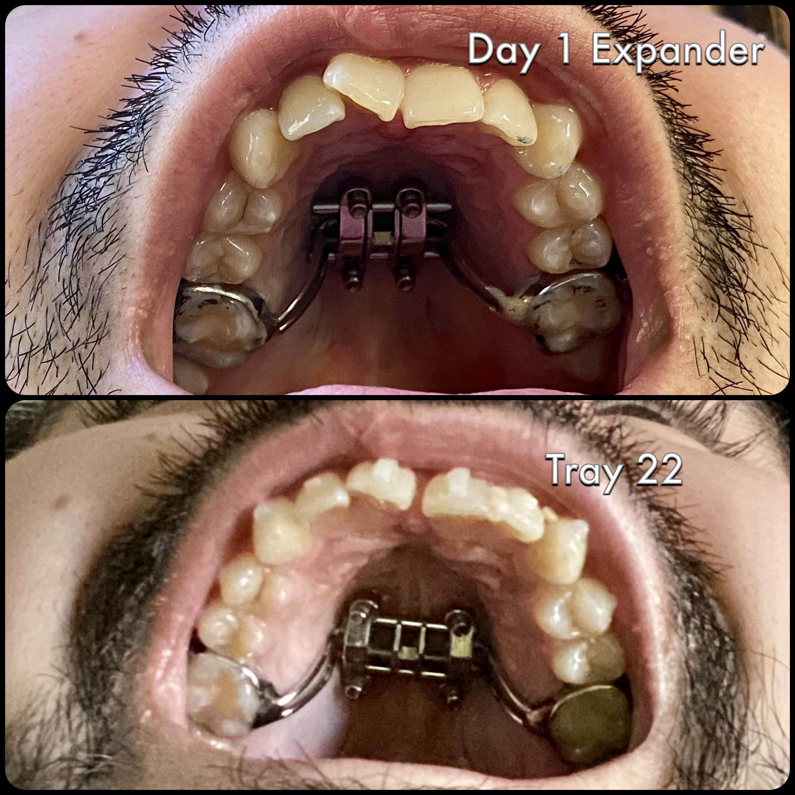 Started the Invisalign journey on Oct 1st with the micro screw assisted expander. 5 months later