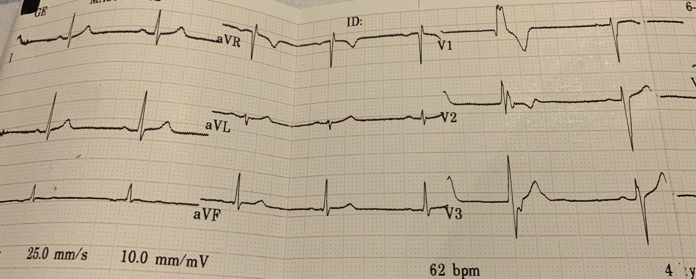 Where is this PVC coming from? r/ReadMyECG