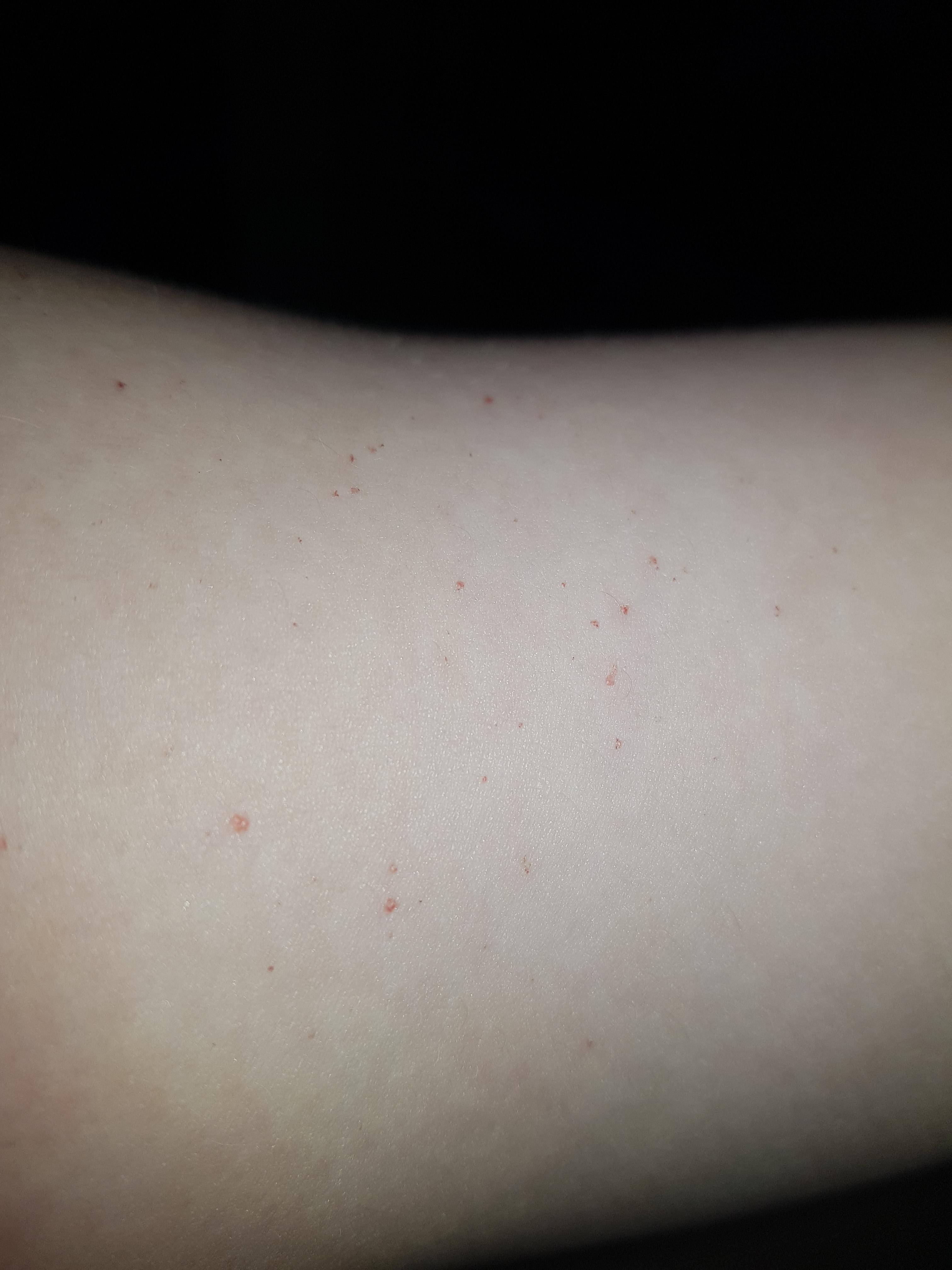 cherry angioma? r/Dermatology