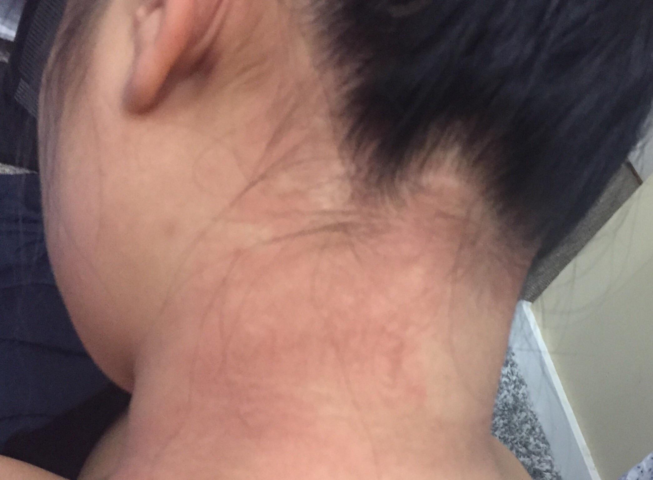 Eczema? I’ve never had it like this before. Came from nowhere. I