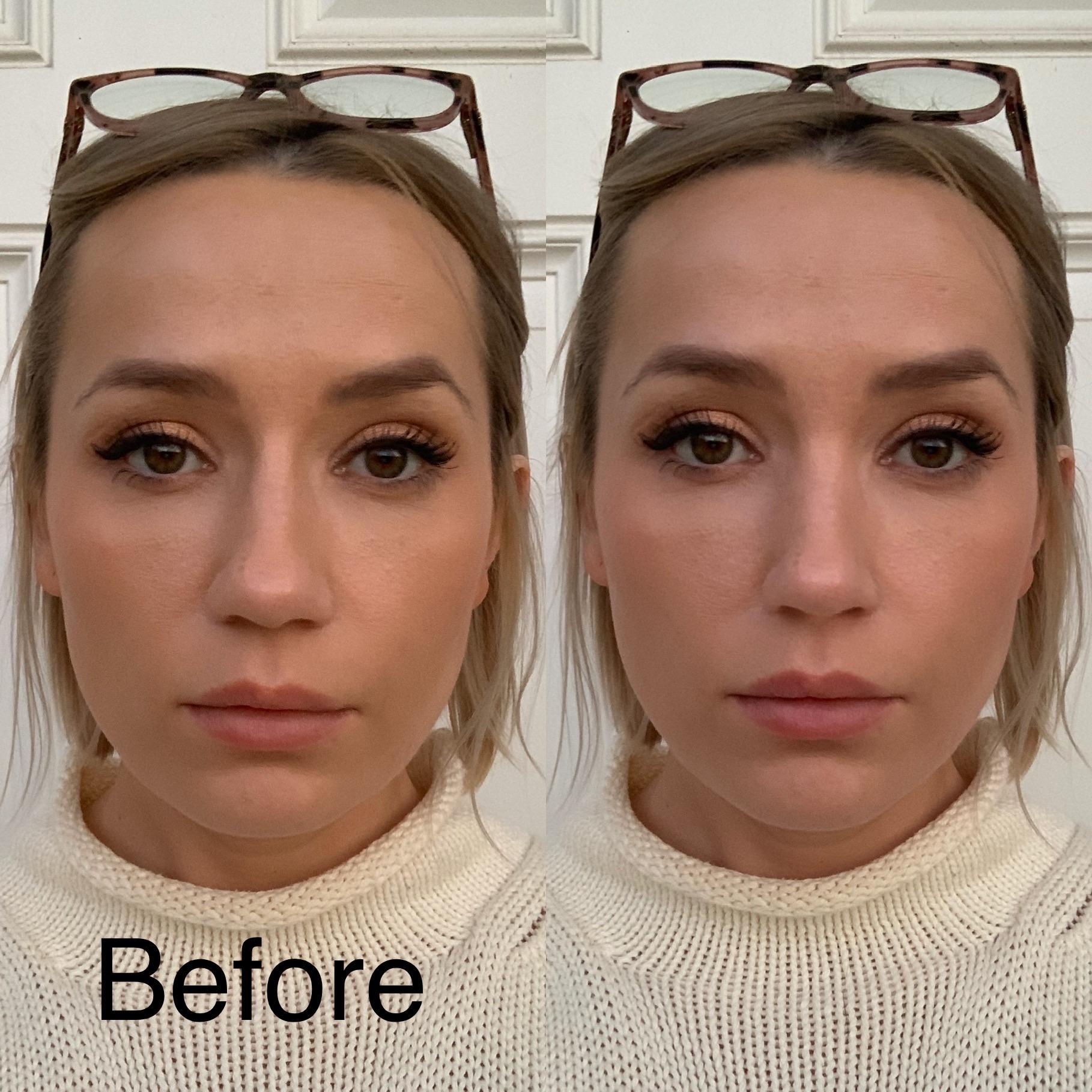 Open Septorhinoplasty Surgical Demonstration